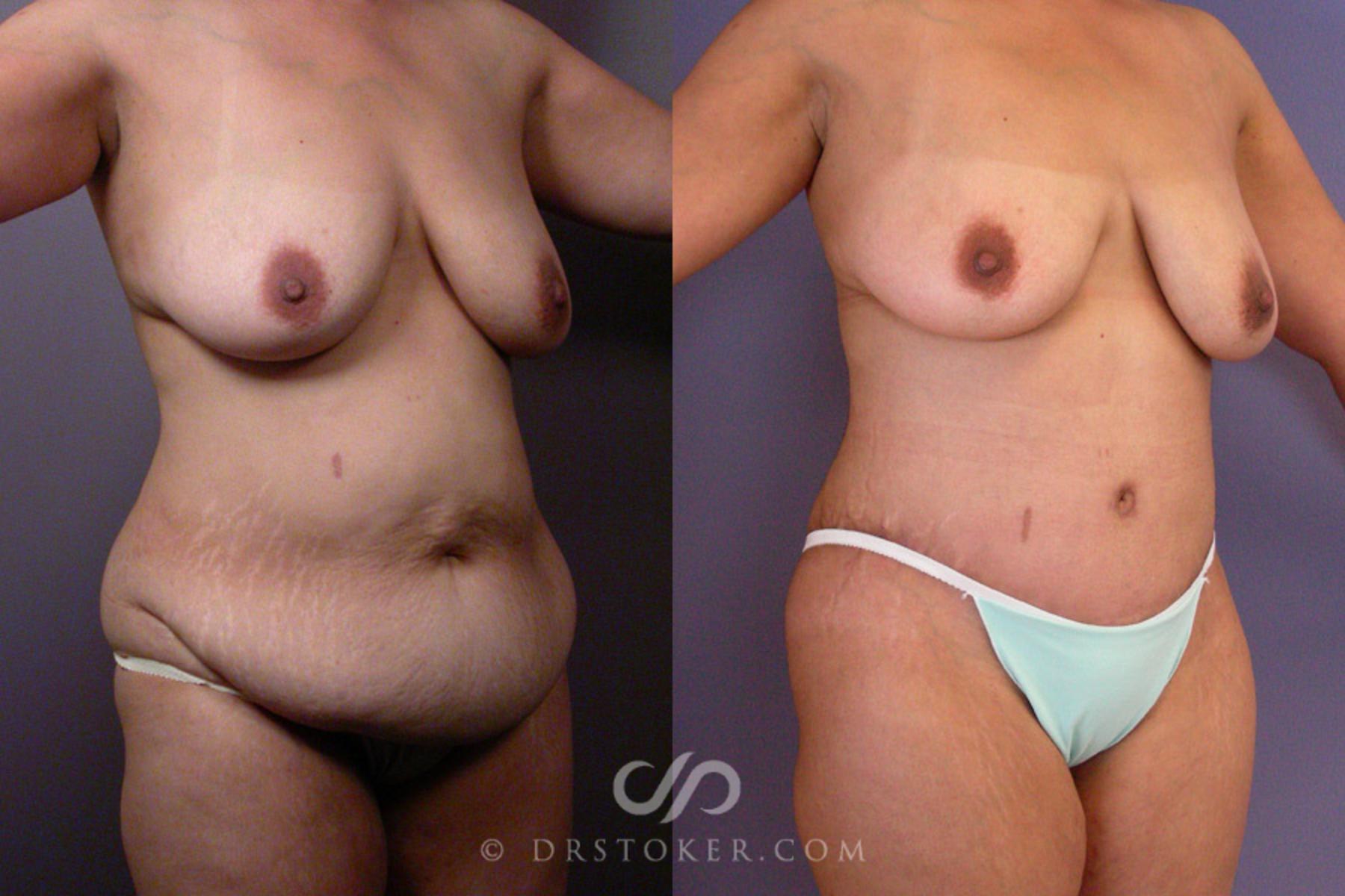 Before & After After Weight Loss Case 354 View #2 View in Los Angeles, CA
