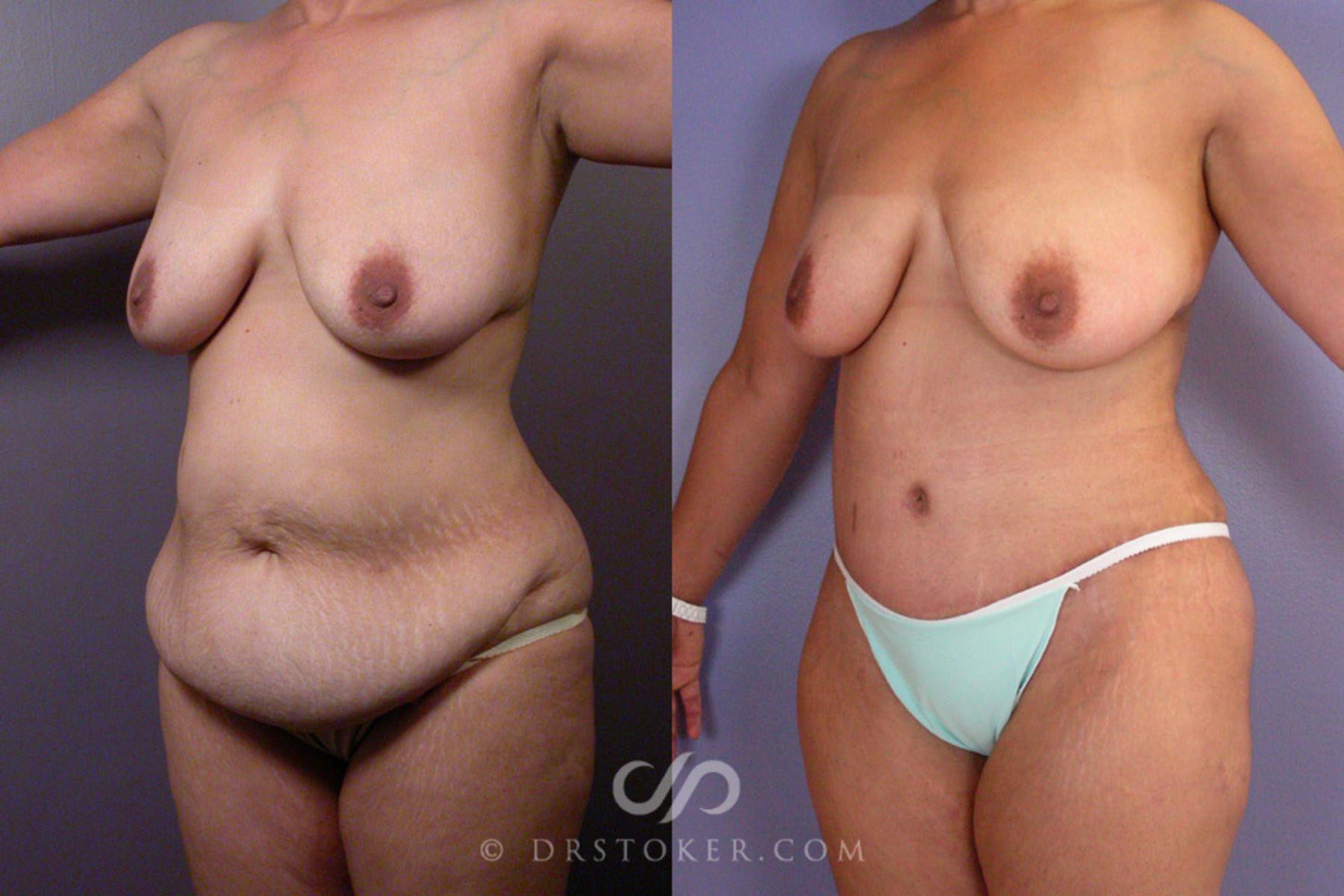 Before & After After Weight Loss Case 354 View #3 View in Los Angeles, CA