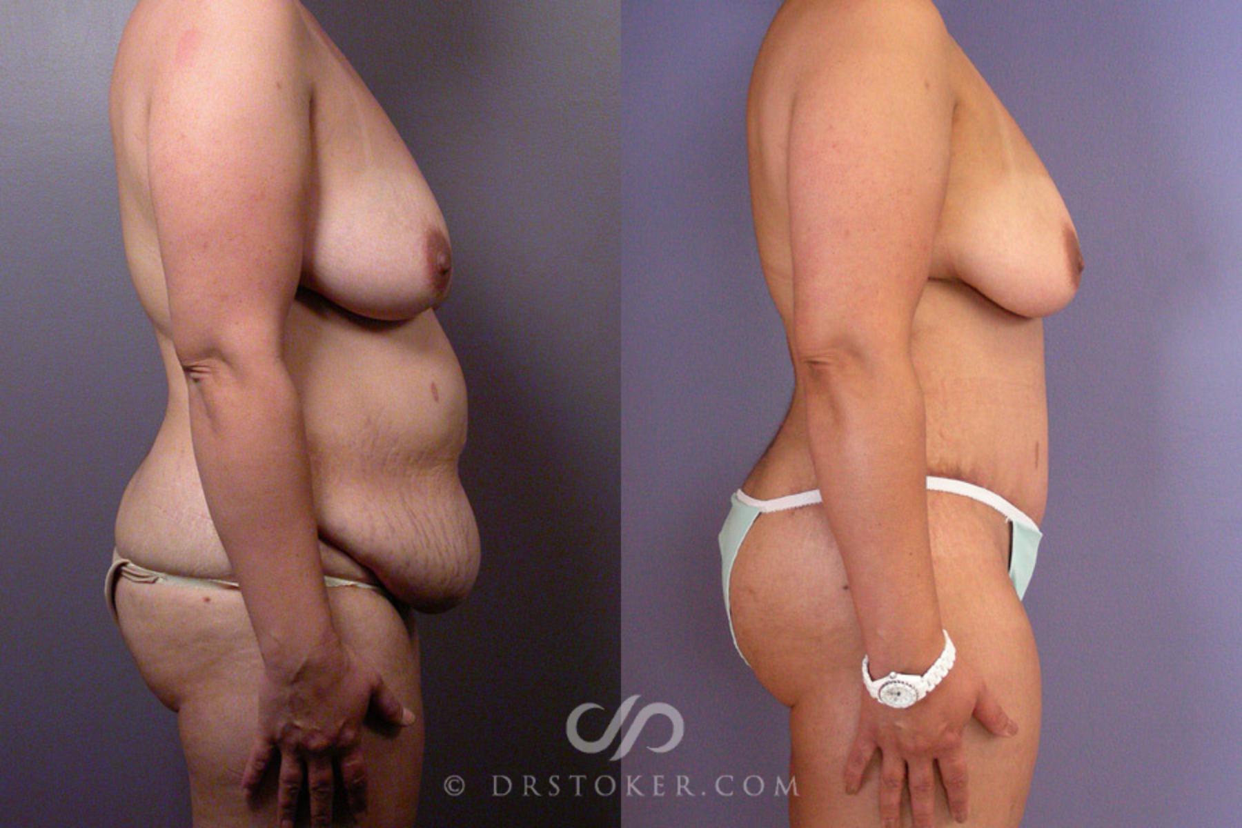 Before & After Tummy Tuck Case 354 View #4 View in Los Angeles, CA