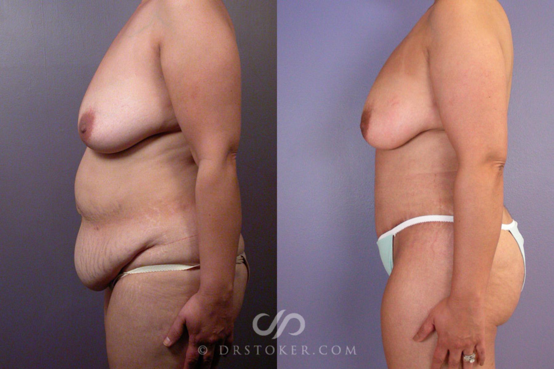 Before & After Tummy Tuck Case 354 View #5 View in Los Angeles, CA