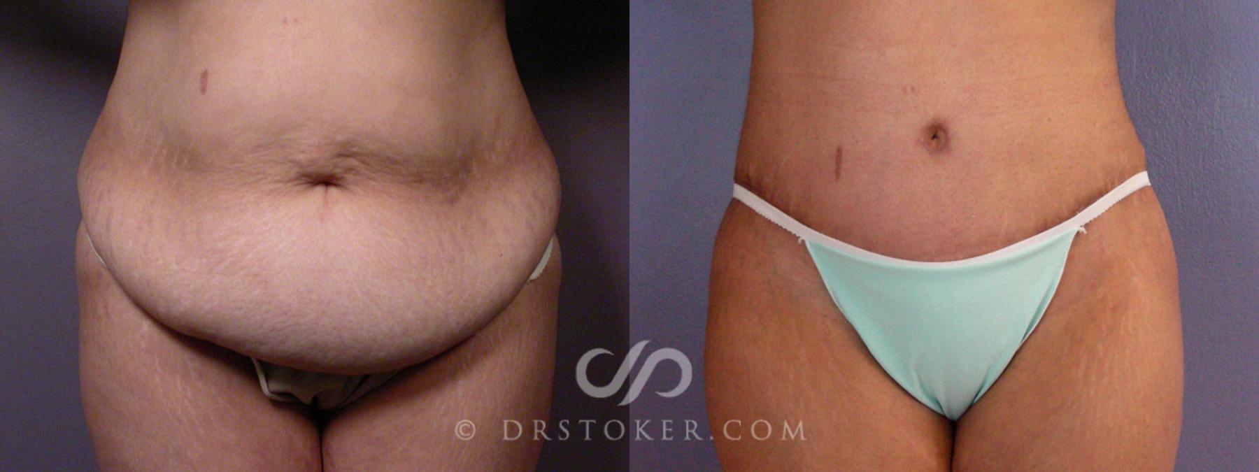 Before & After Tummy Tuck Case 354 View #6 View in Los Angeles, CA