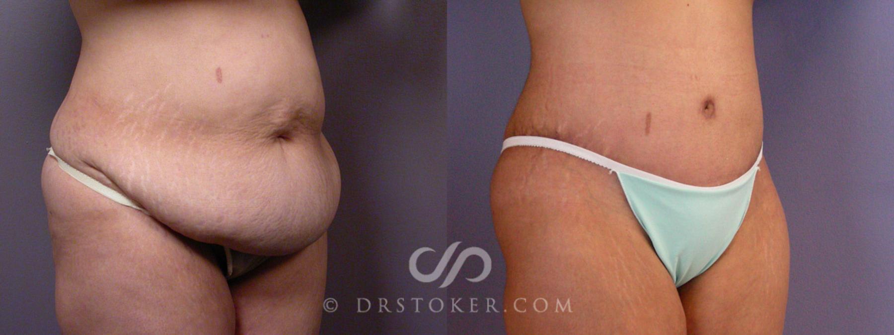 Before & After After Weight Loss Case 354 View #7 View in Los Angeles, CA