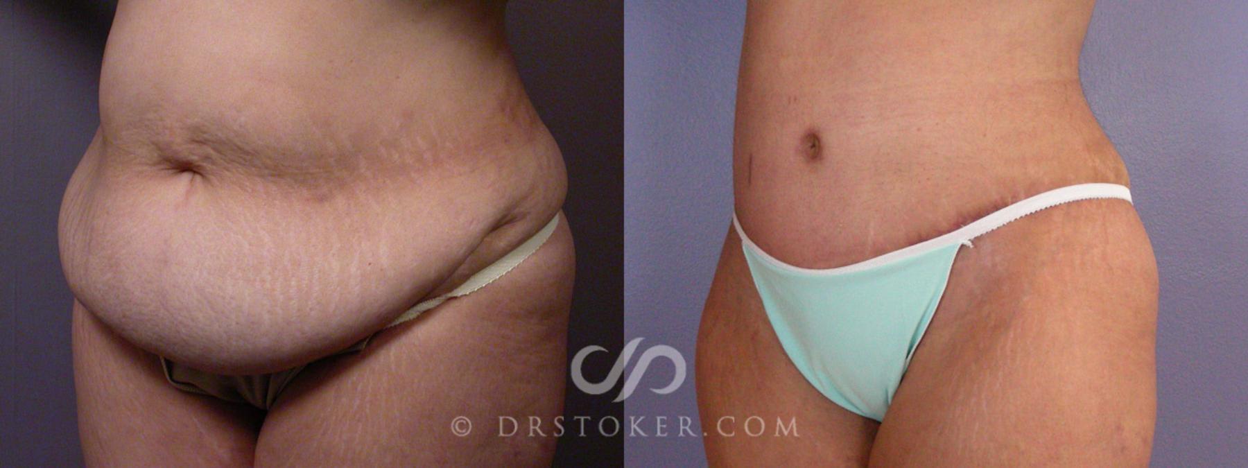 Before & After Tummy Tuck Case 354 View #8 View in Los Angeles, CA