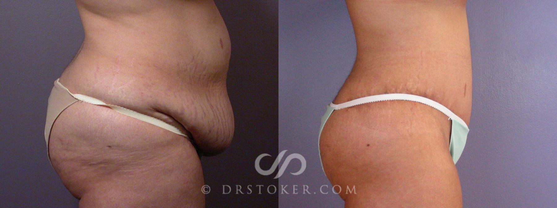 Before & After Tummy Tuck Case 354 View #9 View in Los Angeles, CA