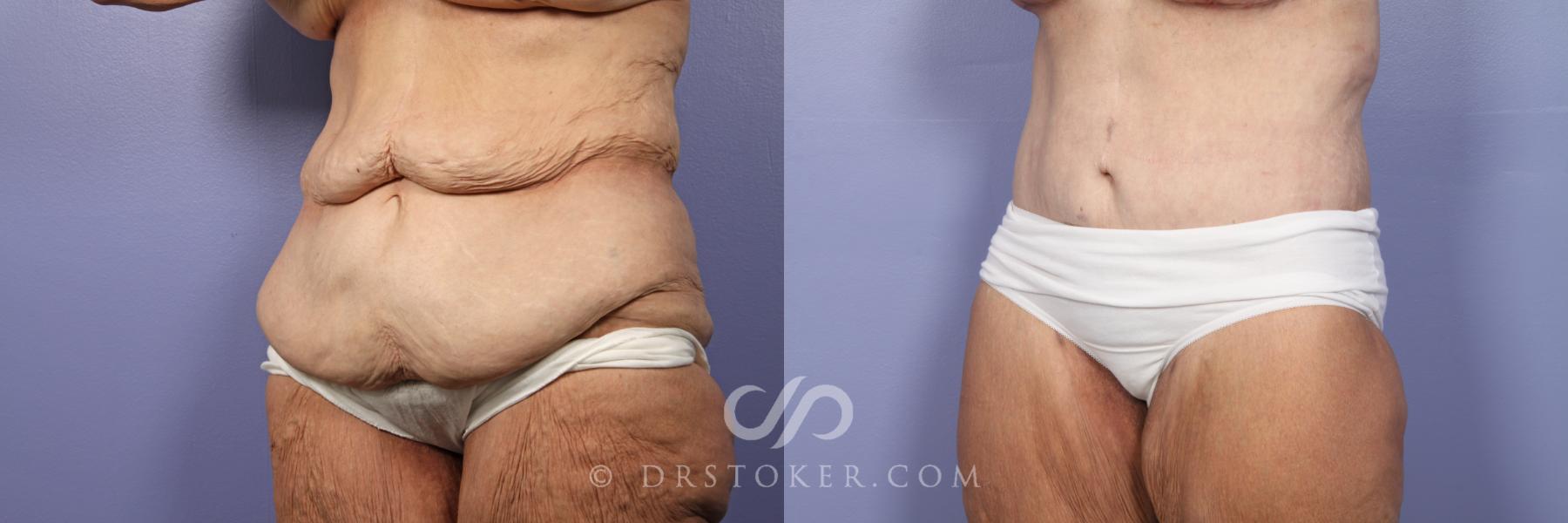 Before & After Tummy Tuck Case 500 View #3 View in Los Angeles, CA