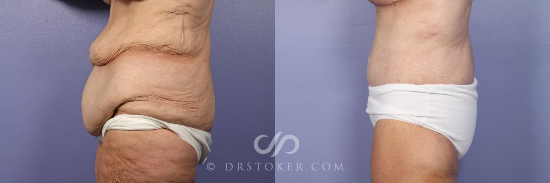 Before & After After Weight Loss Case 500 View #4 View in Los Angeles, CA