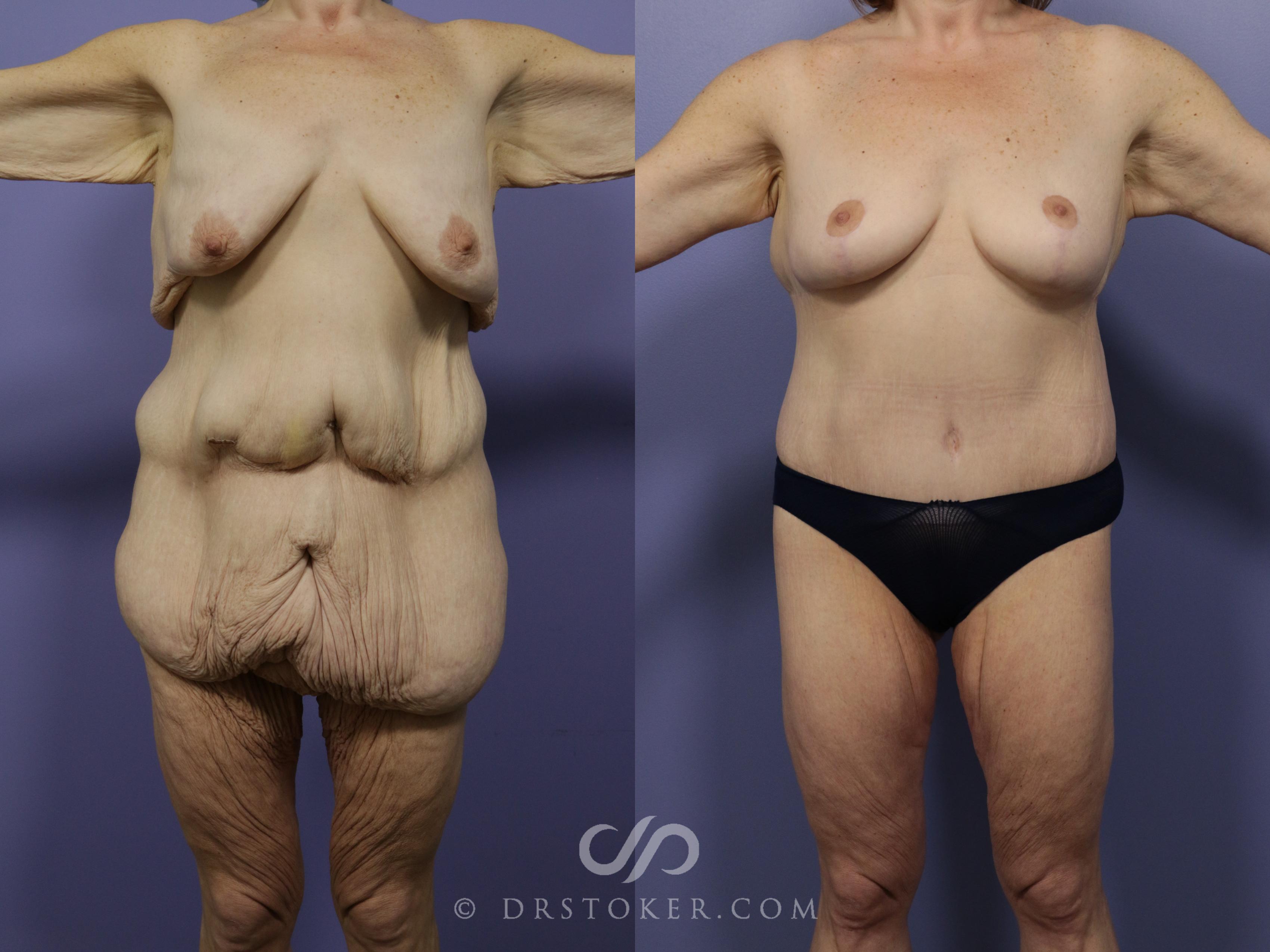 Before & After After Weight Loss Case 544 View #1 View in Los Angeles, CA