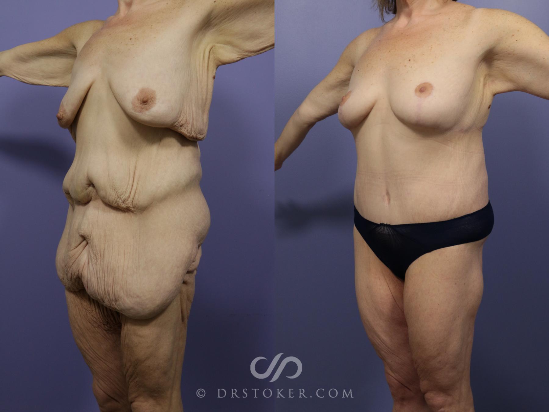 Before & After After Weight Loss Case 544 View #2 View in Los Angeles, CA