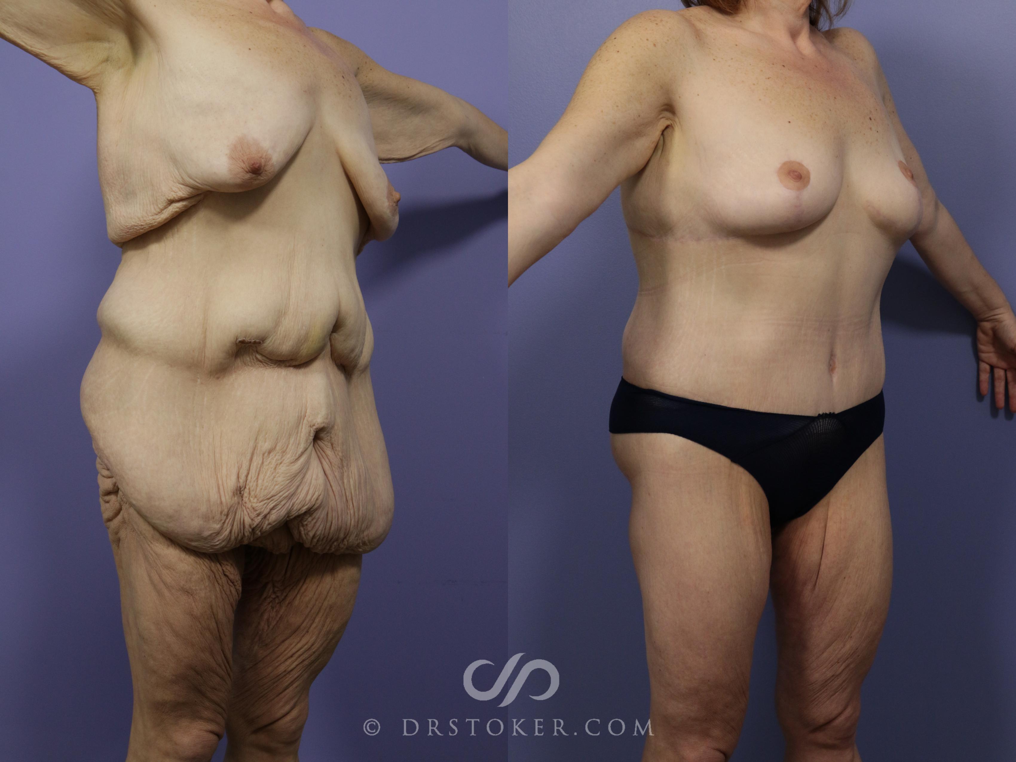 Before & After After Weight Loss Case 545 View #1 View in Marina del Rey, CA
