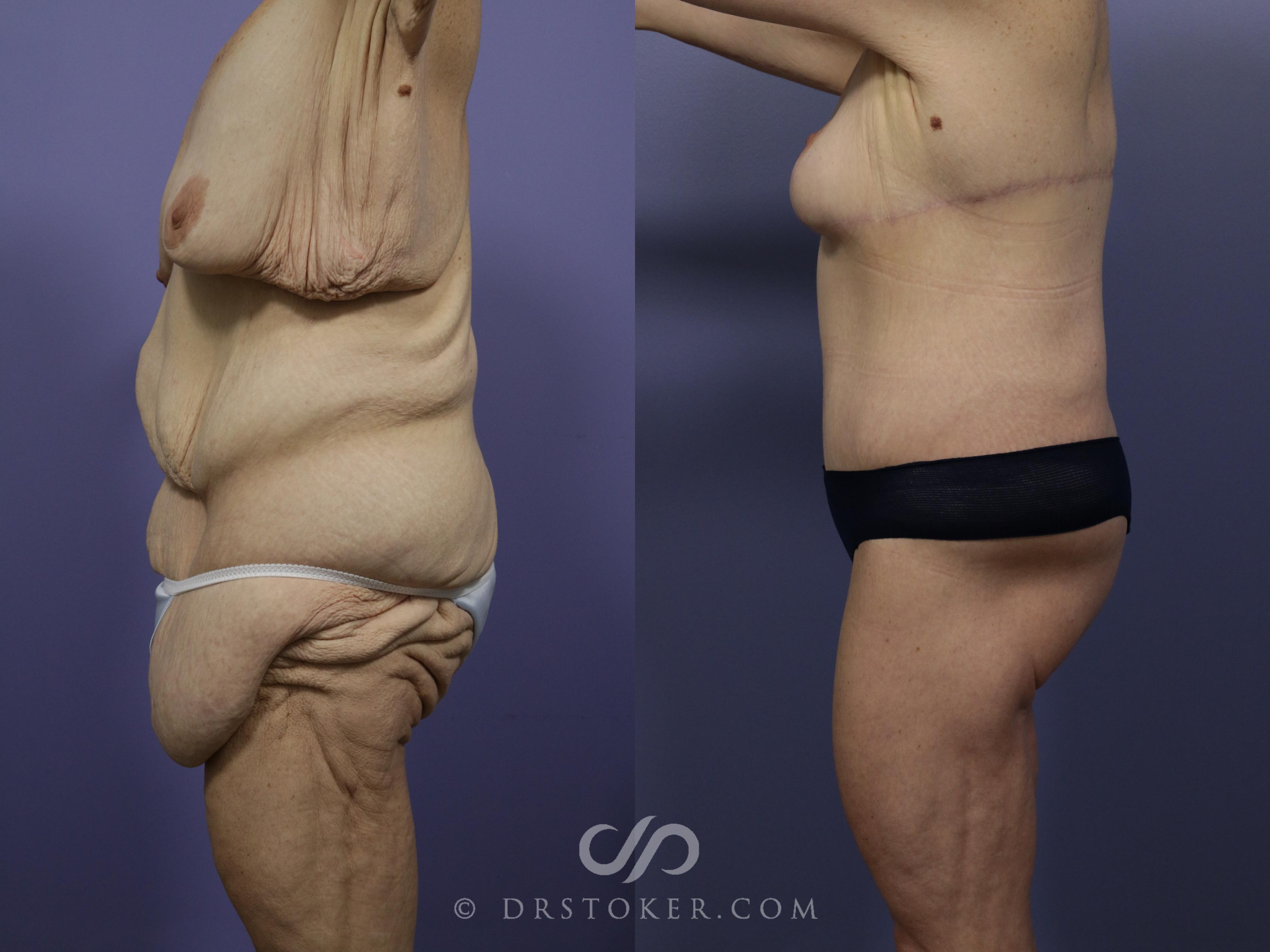 Before & After After Weight Loss Case 545 View #2 View in Los Angeles, CA