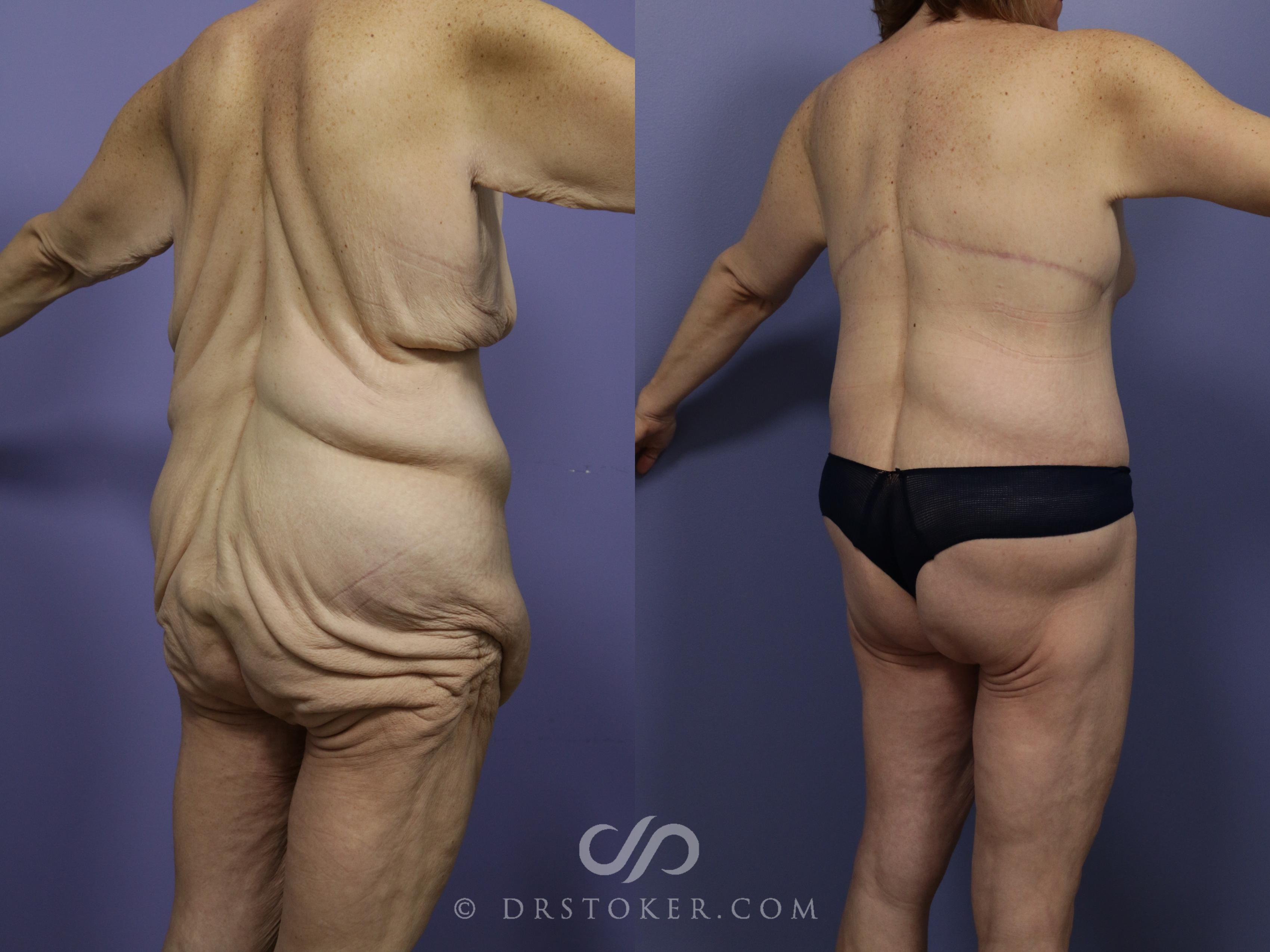 Before & After After Weight Loss Case 546 View #1 View in Marina del Rey, CA