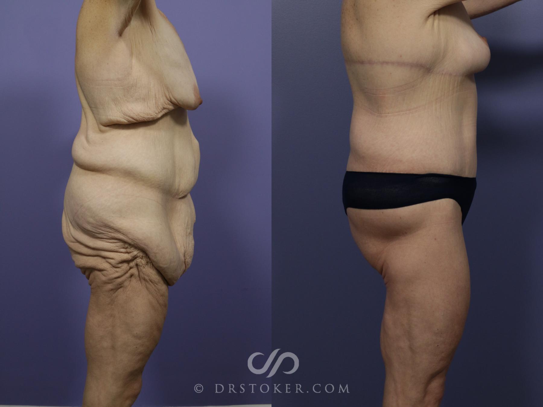 Before & After After Weight Loss Case 546 View #2 View in Los Angeles, CA