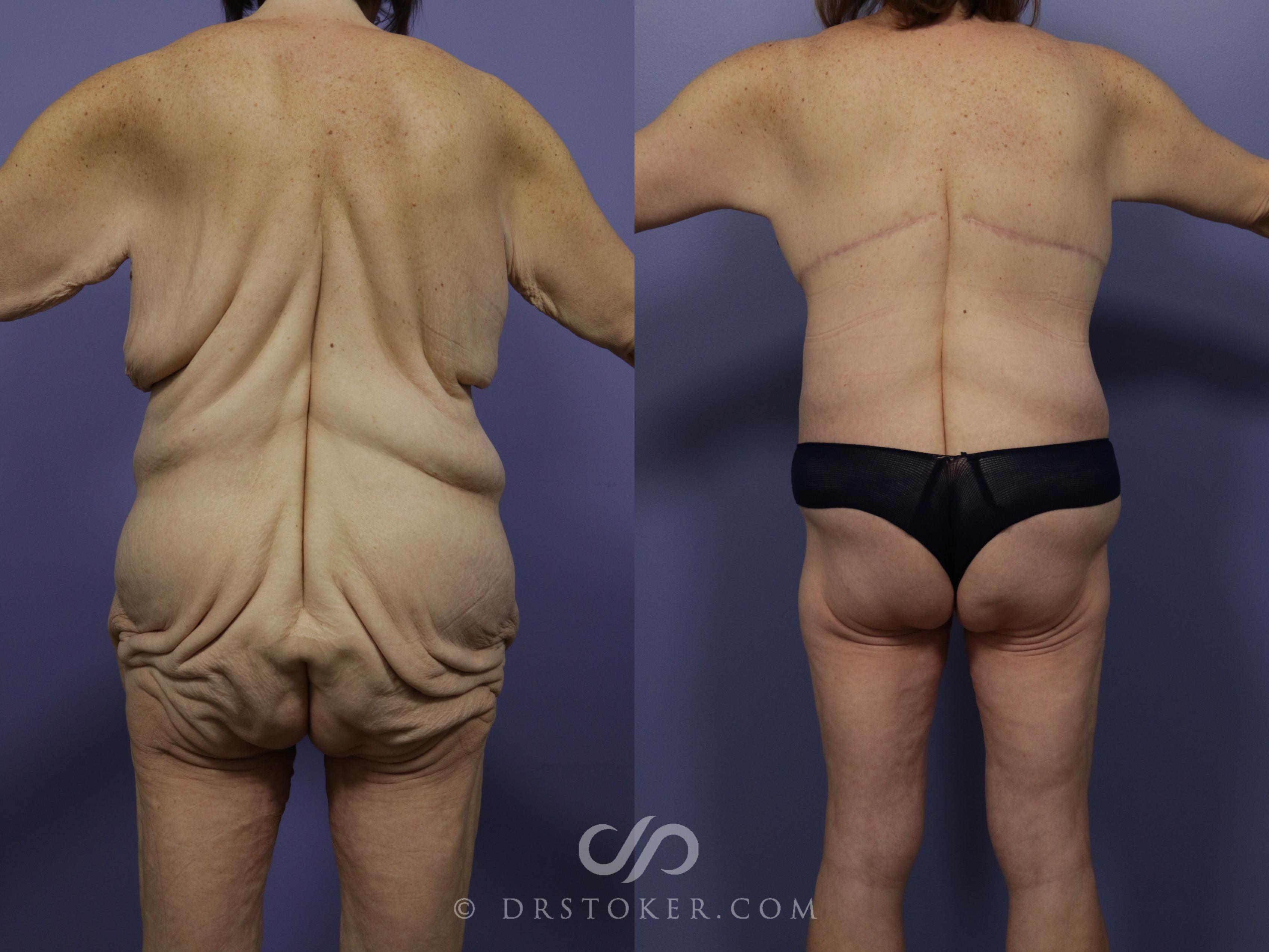 Bra roll liposuction