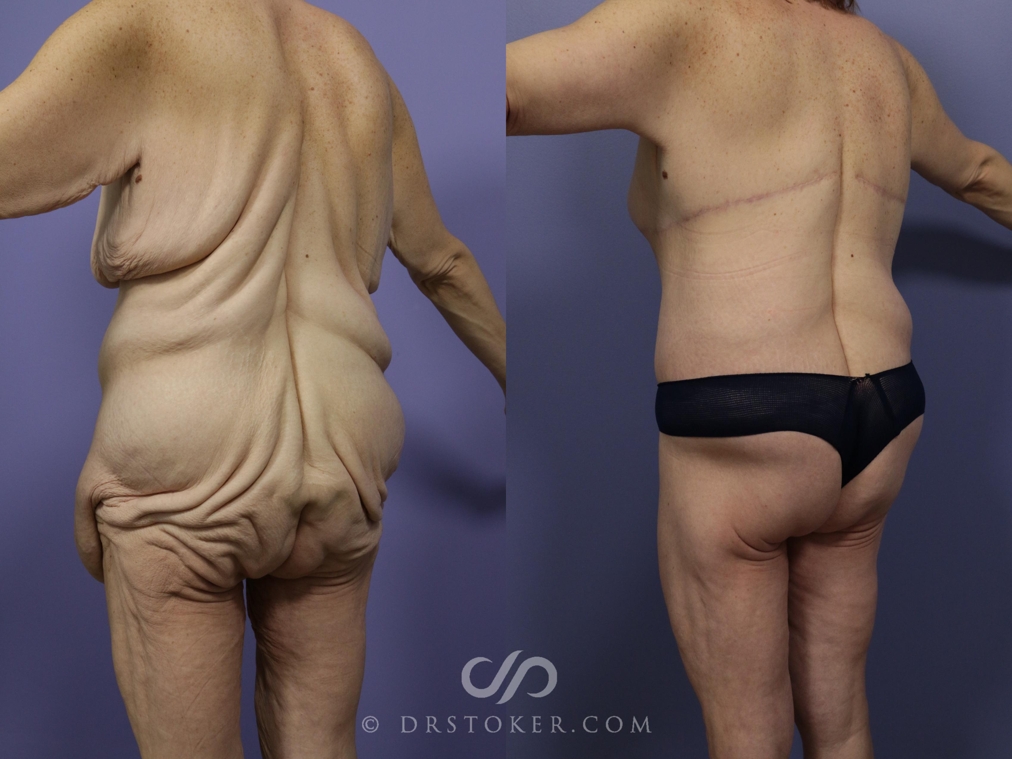 Before & After After Weight Loss Case 547 View #2 View in Los Angeles, CA