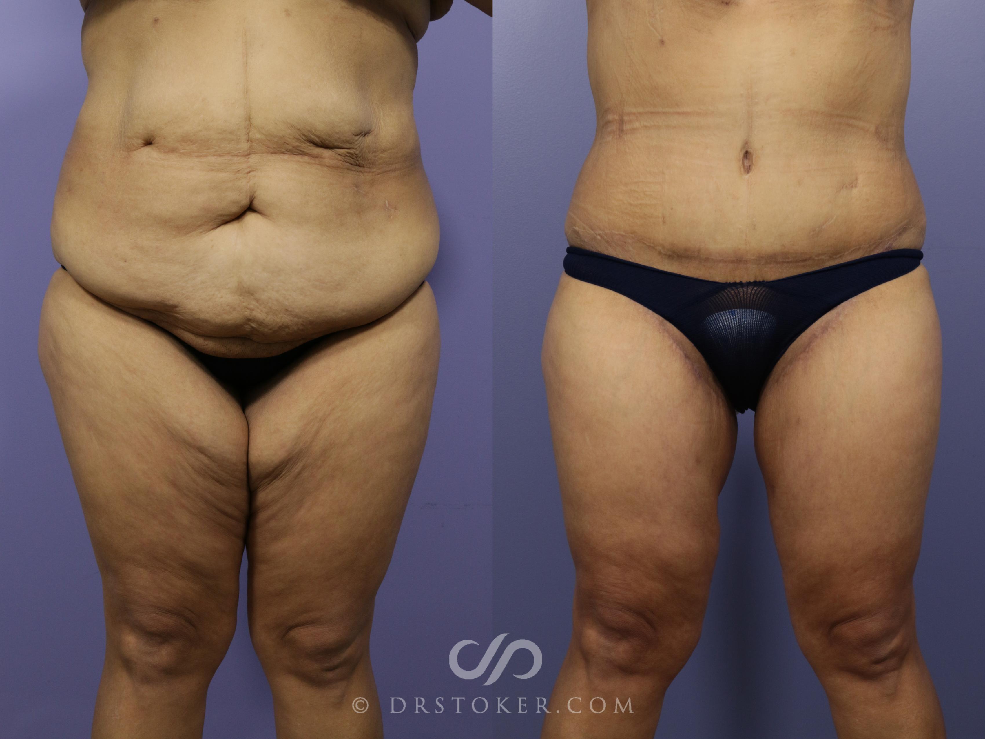 Before & After After Weight Loss Case 550 View #1 View in Los Angeles, CA