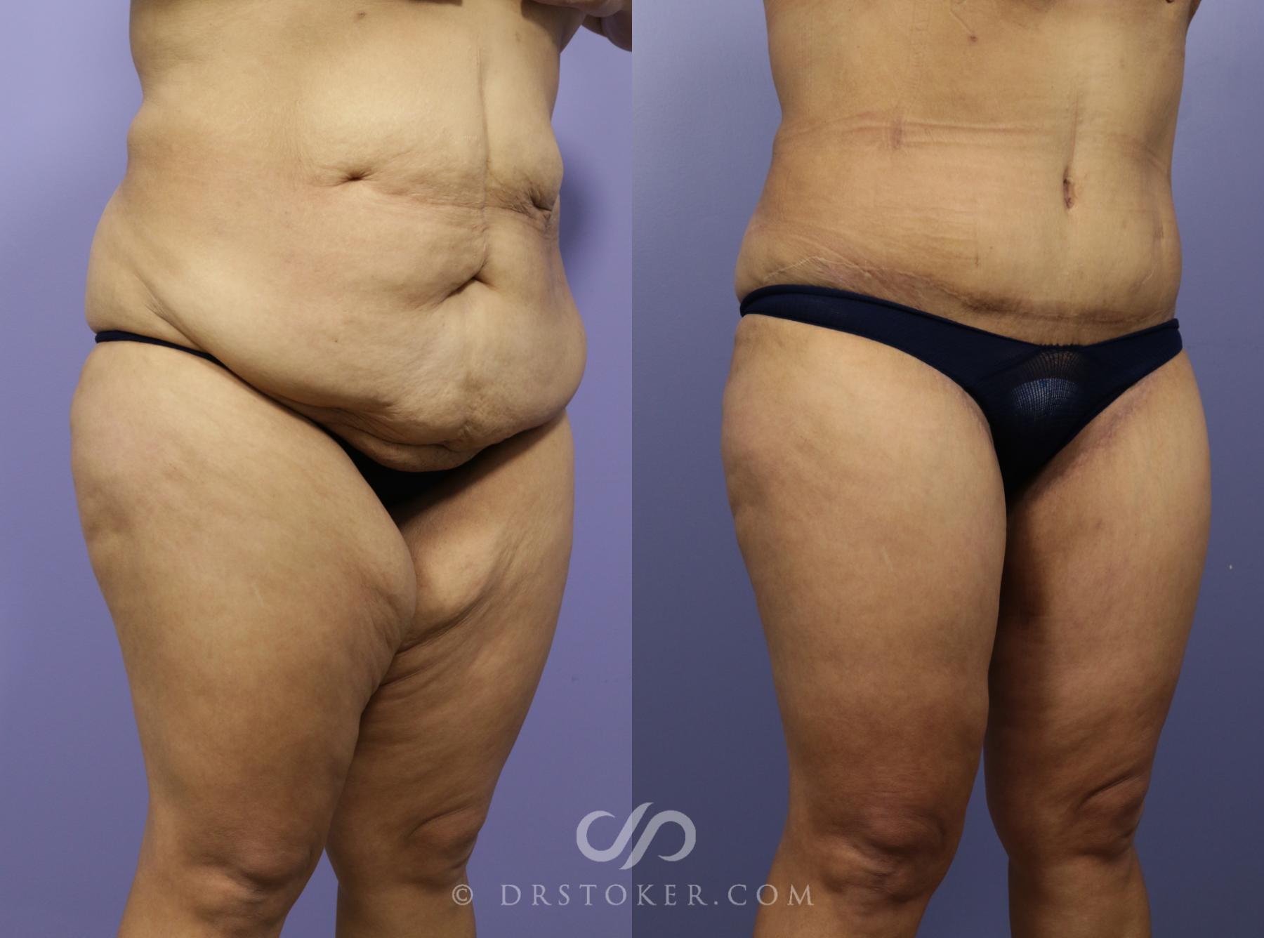 Before & After After Weight Loss Case 550 View #2 View in Los Angeles, CA