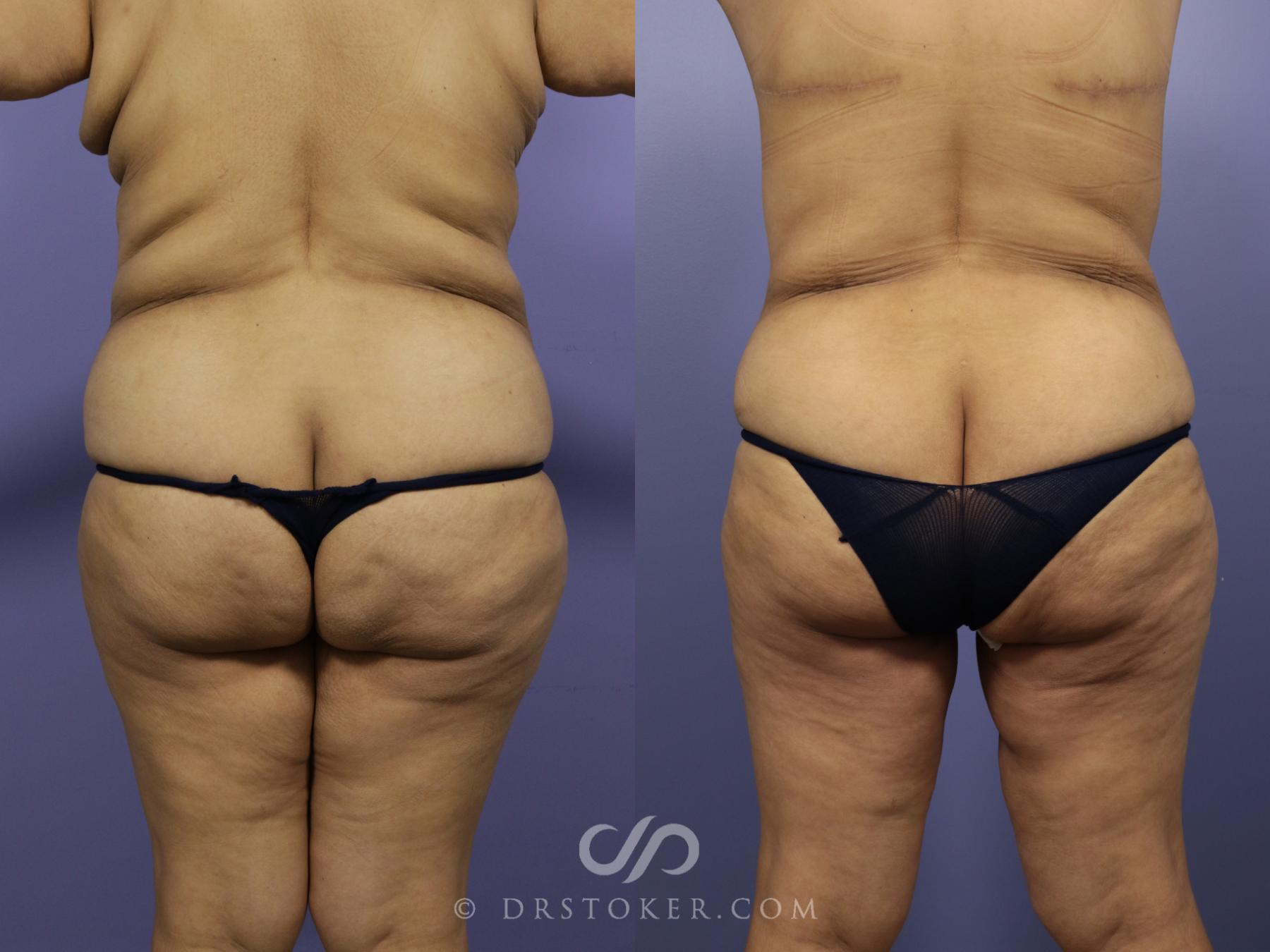 Before & After After Weight Loss Case 550 View #3 View in Los Angeles, CA