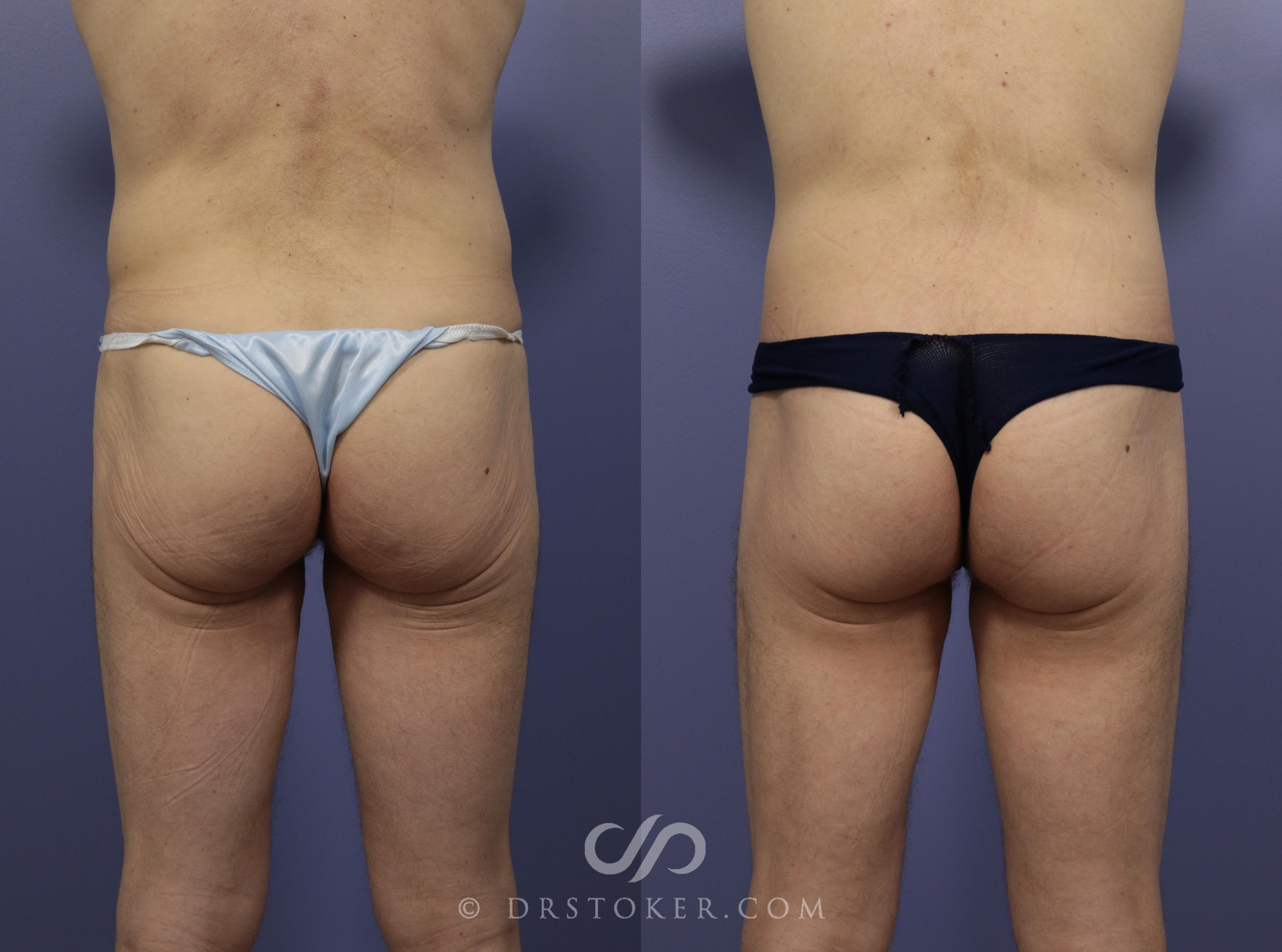 Before & After After Weight Loss Case 633 View #1 View in Los Angeles, CA