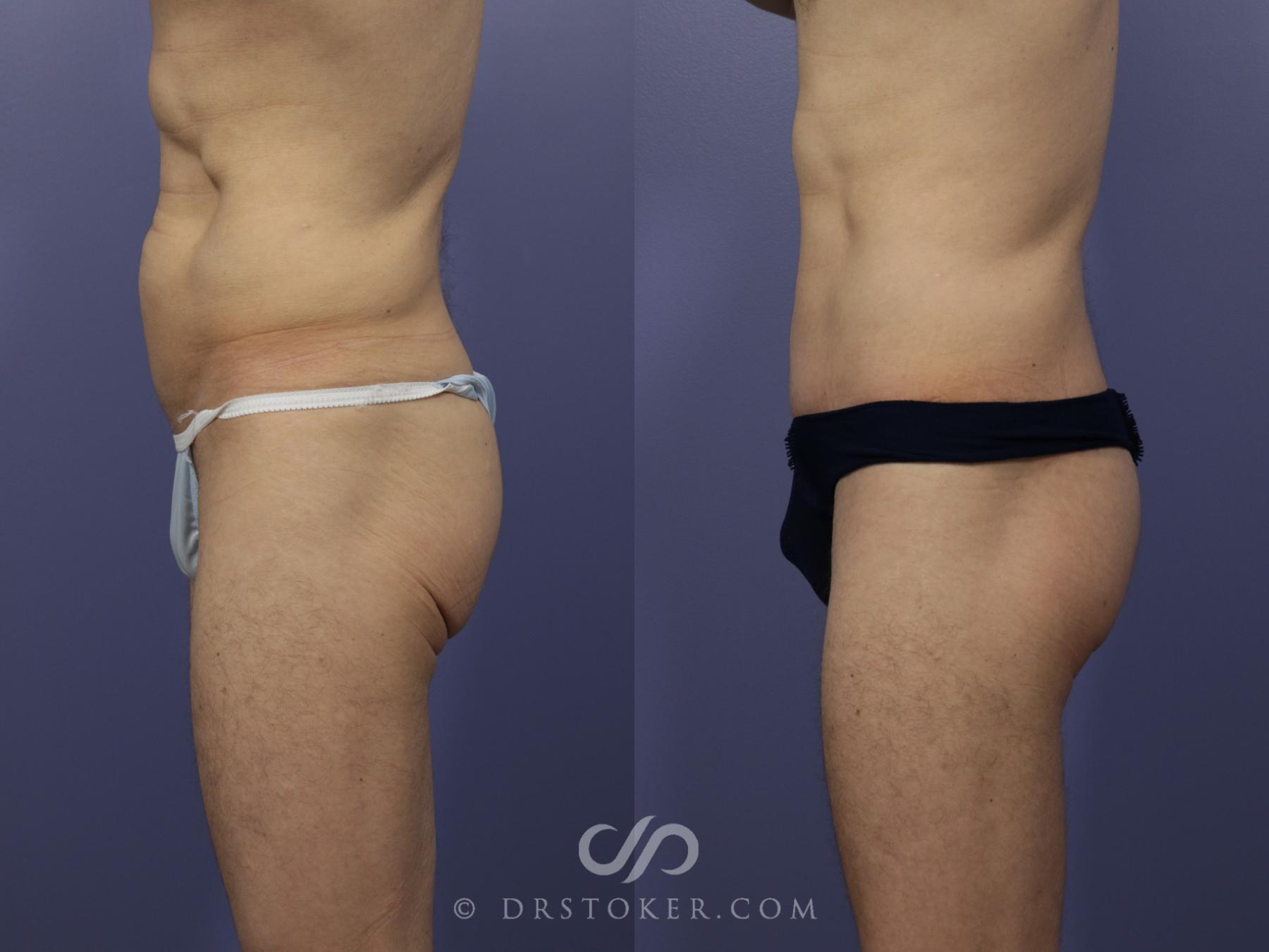 Before & After After Weight Loss Case 633 View #4 View in Los Angeles, CA