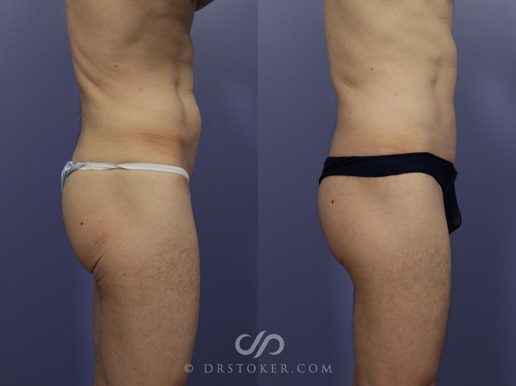 Before & After After Weight Loss Case 633 View #5 View in Los Angeles, CA