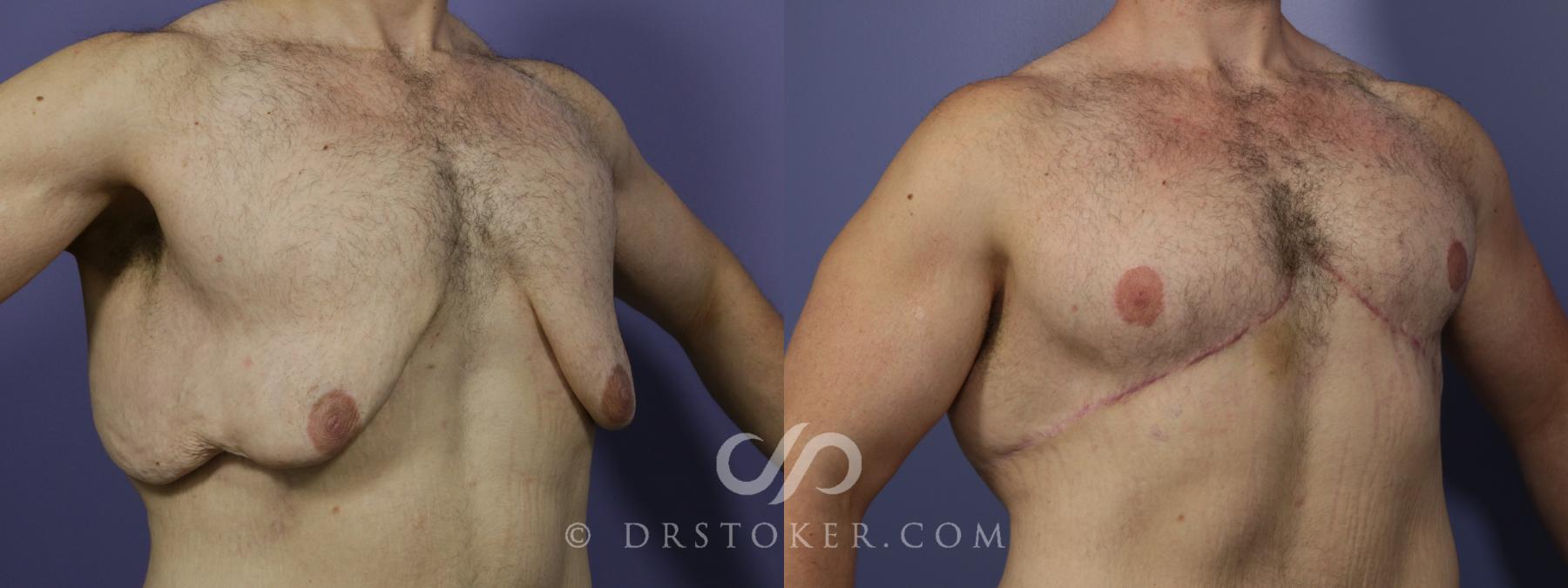 Before & After After Weight Loss Case 638 View #1 View in Los Angeles, CA