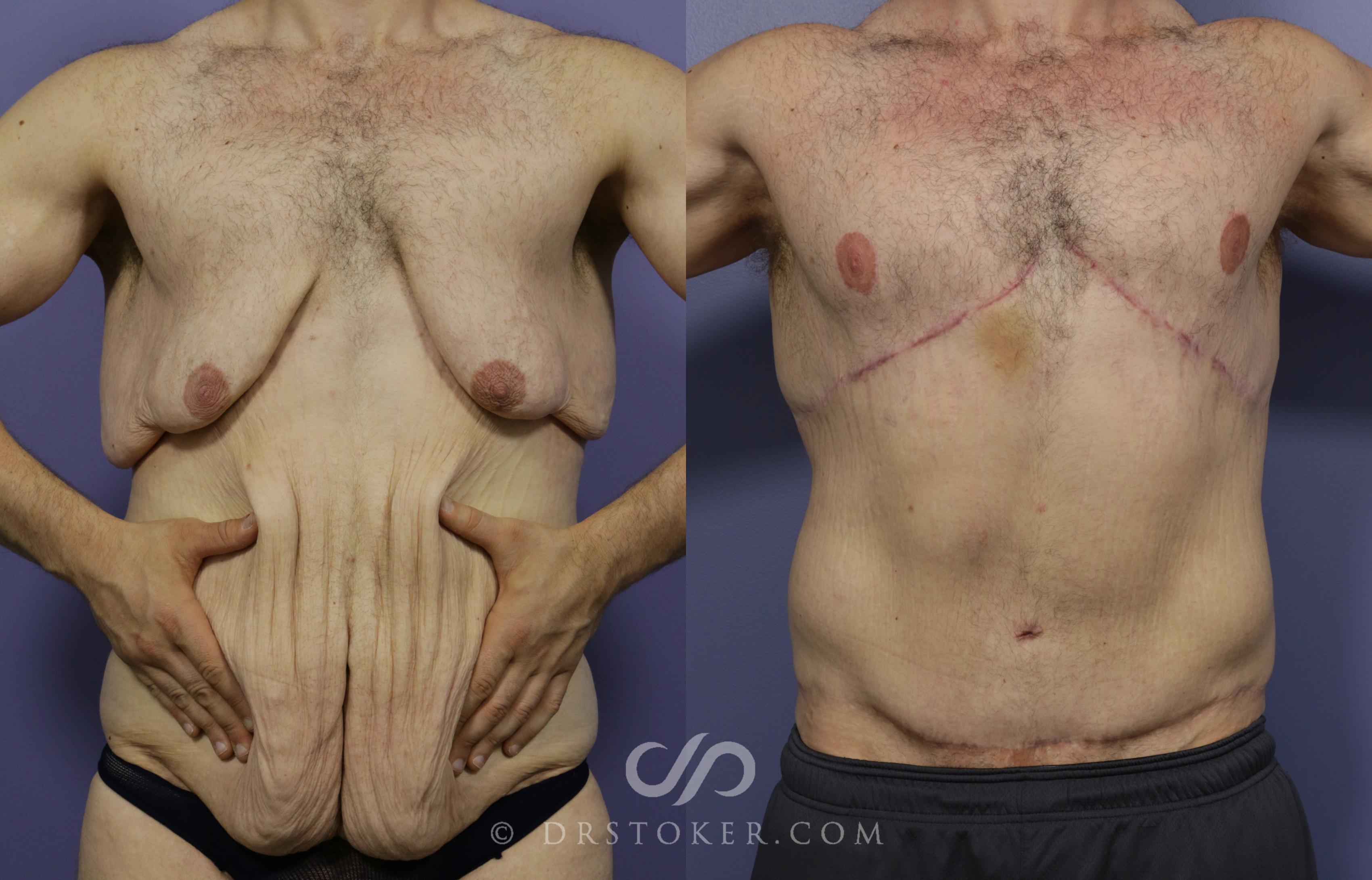 Before & After After Weight Loss Case 640 View #1 View in Los Angeles, CA