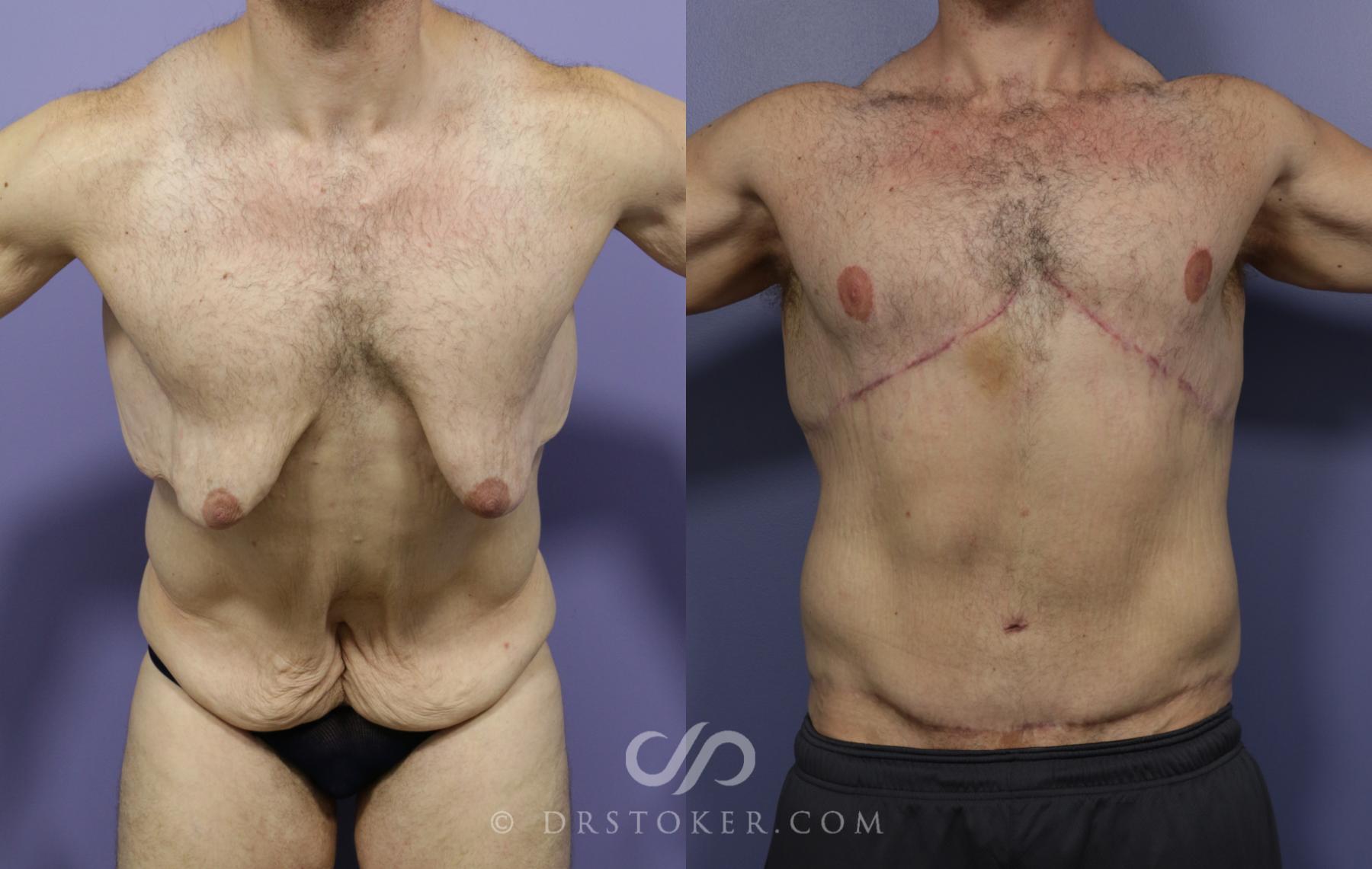 Before & After After Weight Loss Case 641 View #1 View in Los Angeles, CA