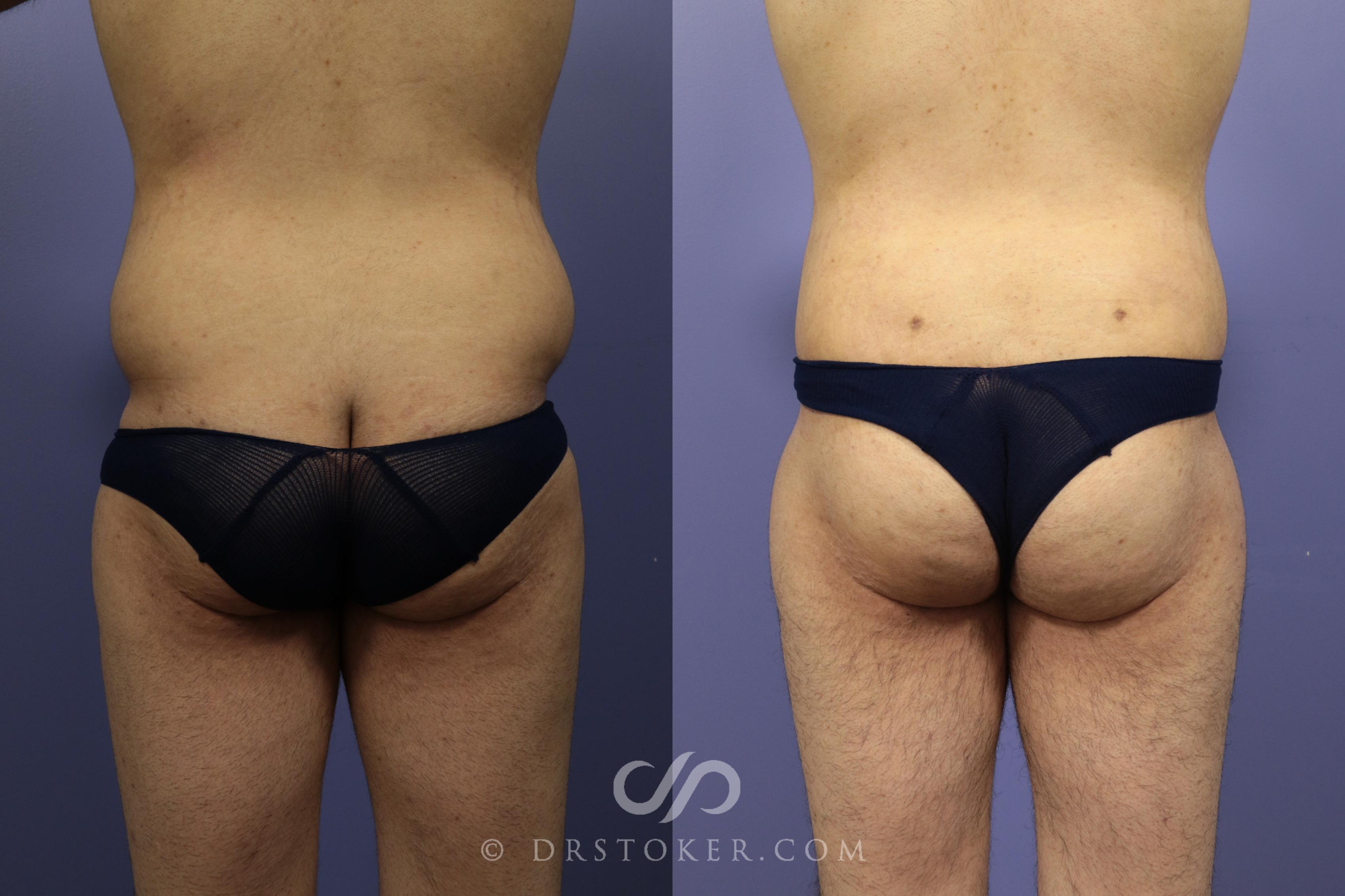 Before & After After Weight Loss Case 644 View #1 View in Los Angeles, CA