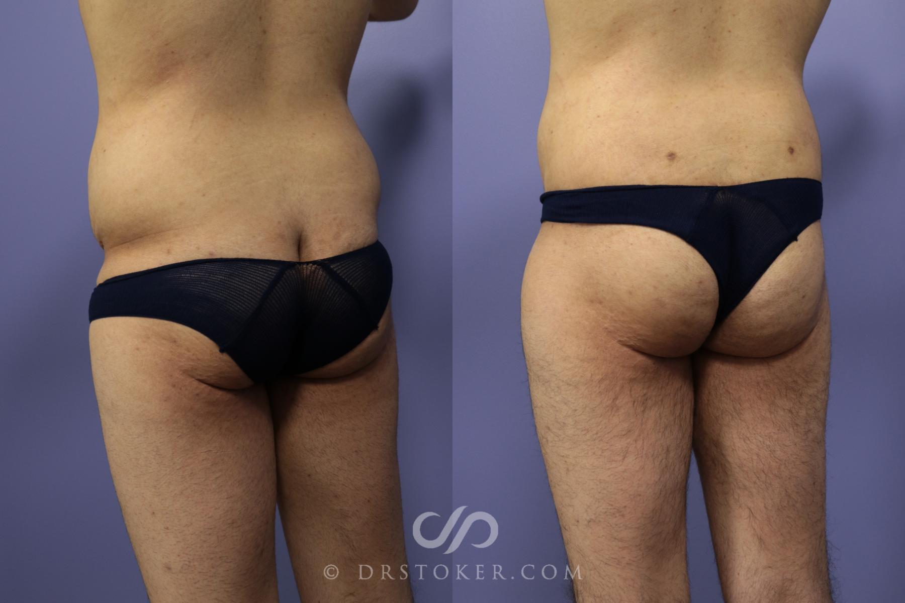 Before & After After Weight Loss Case 644 View #2 View in Los Angeles, CA