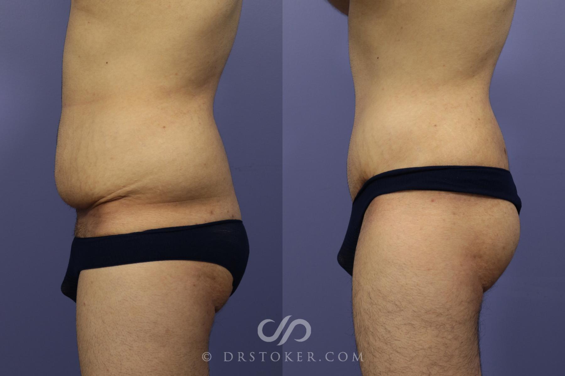 Before & After After Weight Loss Case 644 View #3 View in Los Angeles, CA
