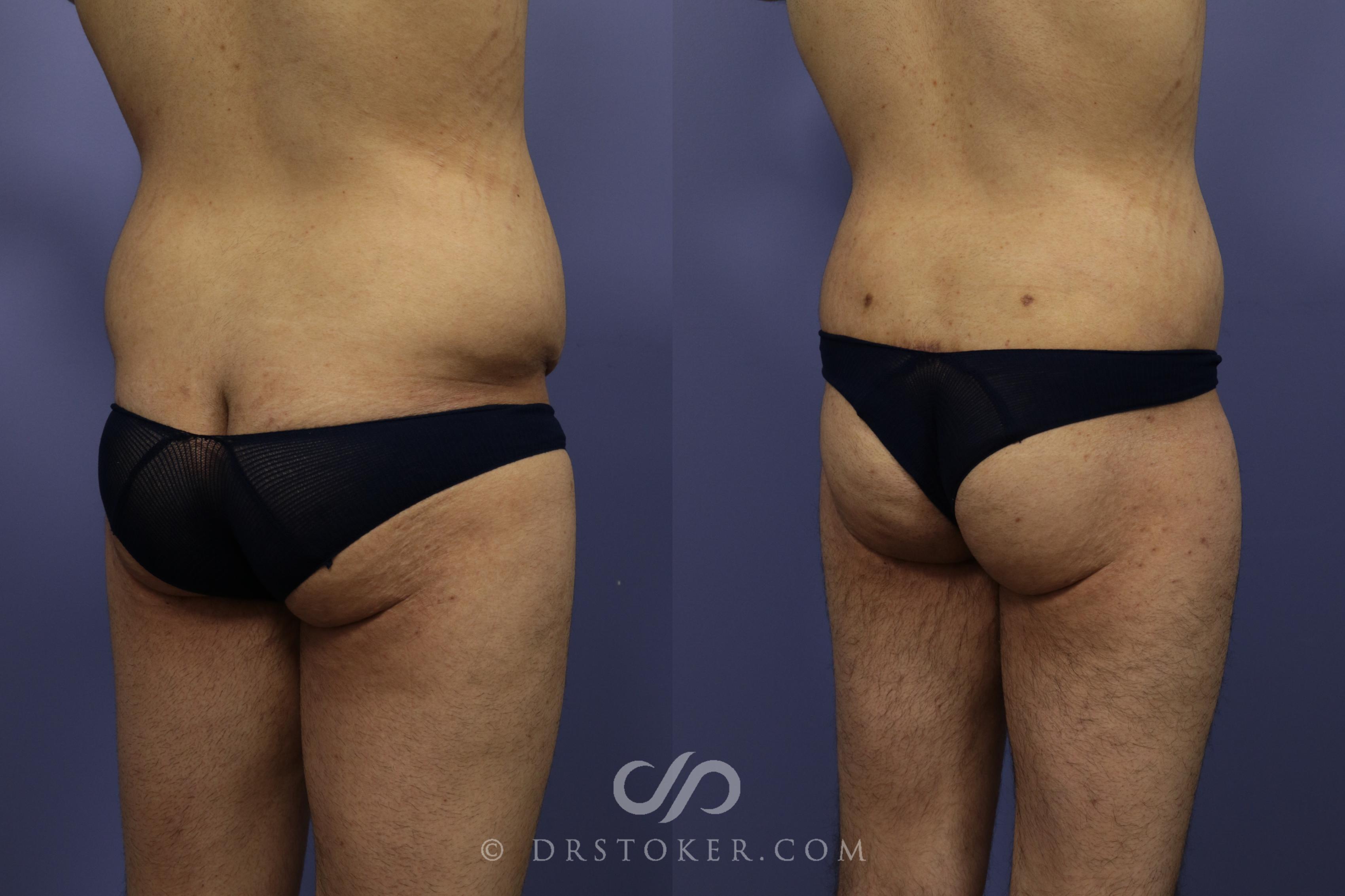 Before & After After Weight Loss Case 644 View #4 View in Los Angeles, CA