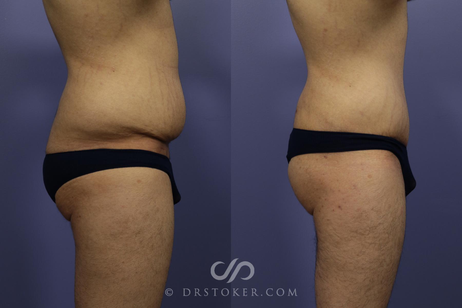 Before & After After Weight Loss Case 644 View #5 View in Los Angeles, CA
