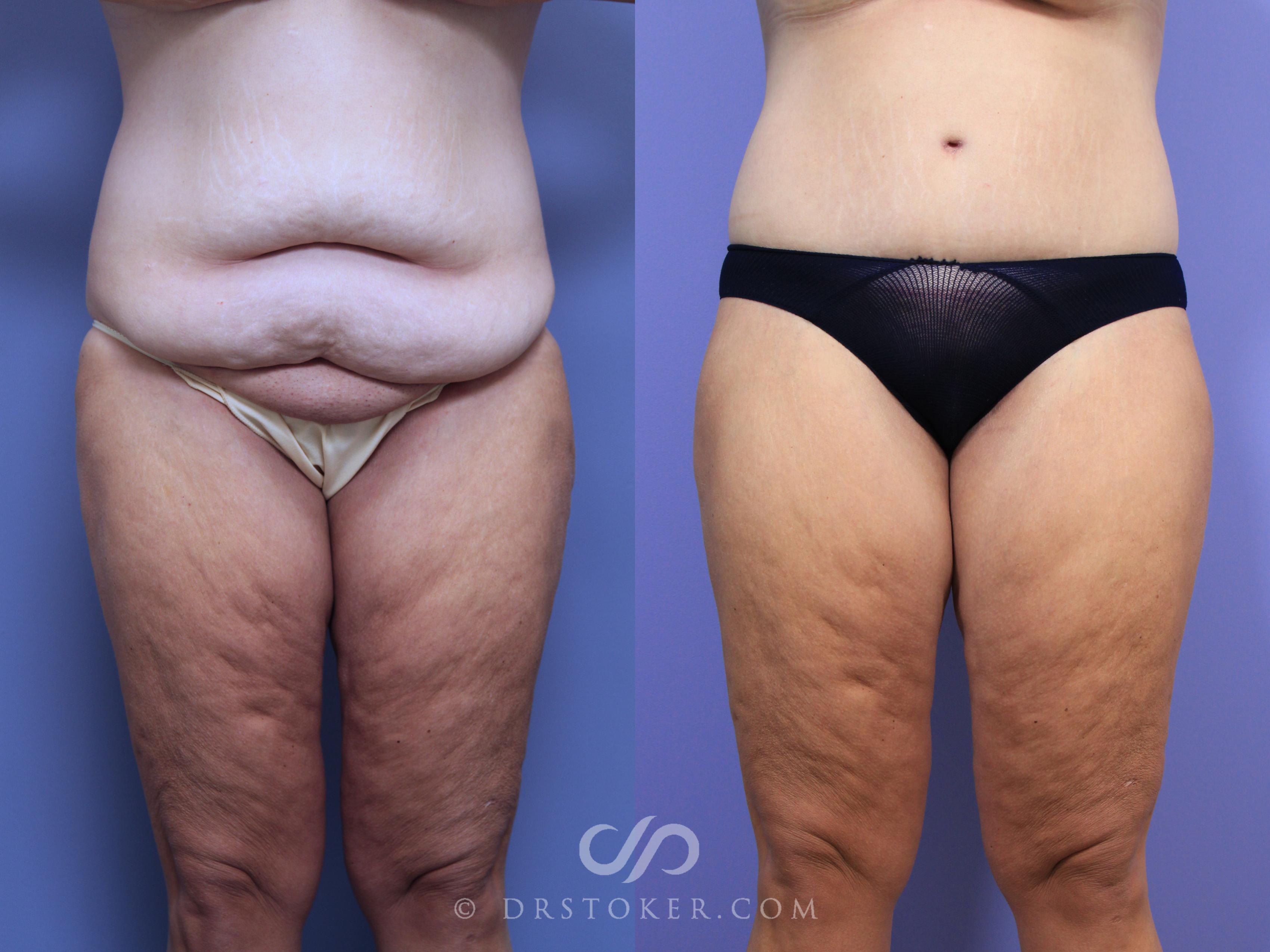 Before & After After Weight Loss Case 645 View #1 View in Los Angeles, CA