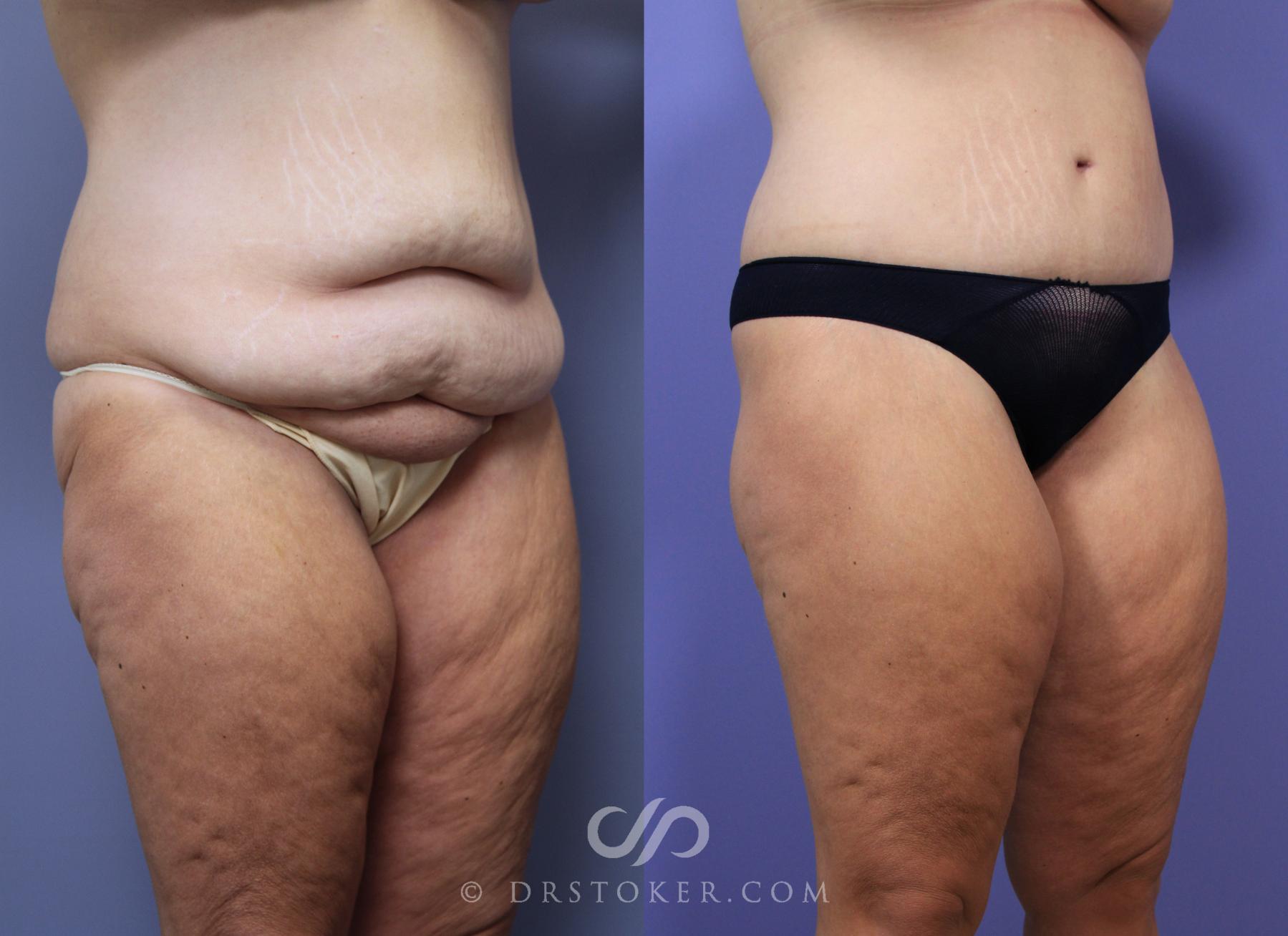 Before & After After Weight Loss Case 645 View #2 View in Los Angeles, CA