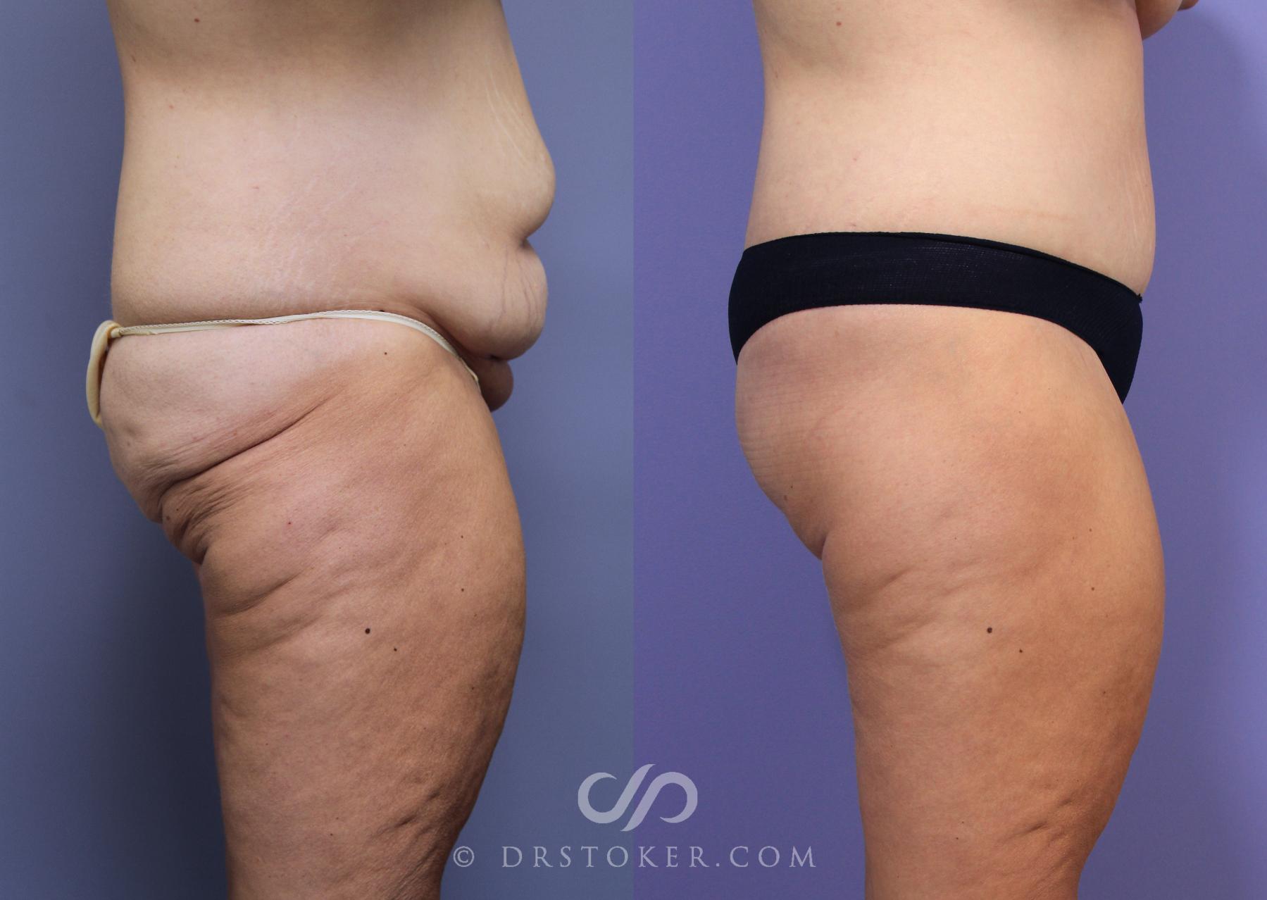 Before & After After Weight Loss Case 645 View #3 View in Los Angeles, CA
