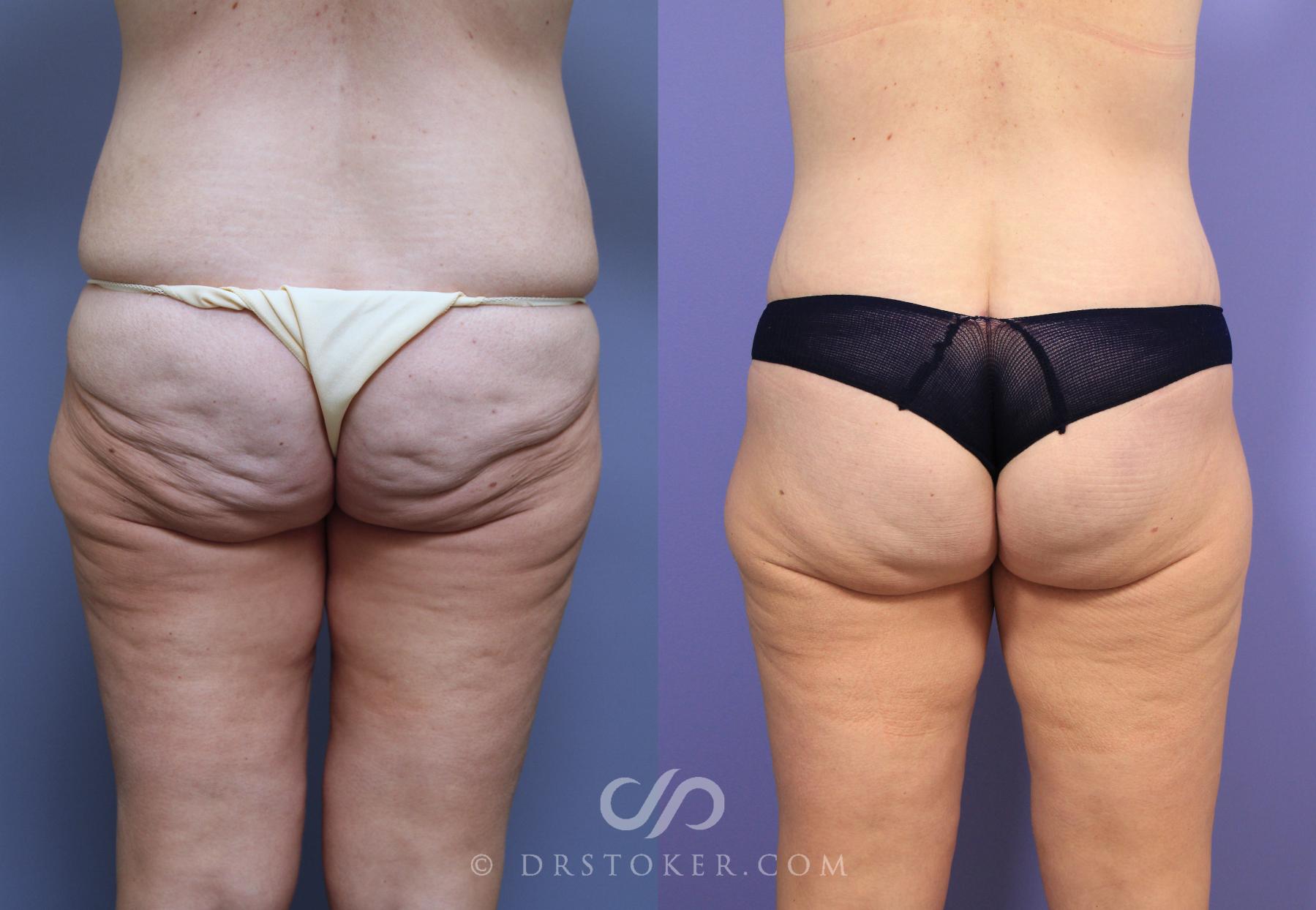Before & After After Weight Loss Case 646 View #1 View in Los Angeles, CA
