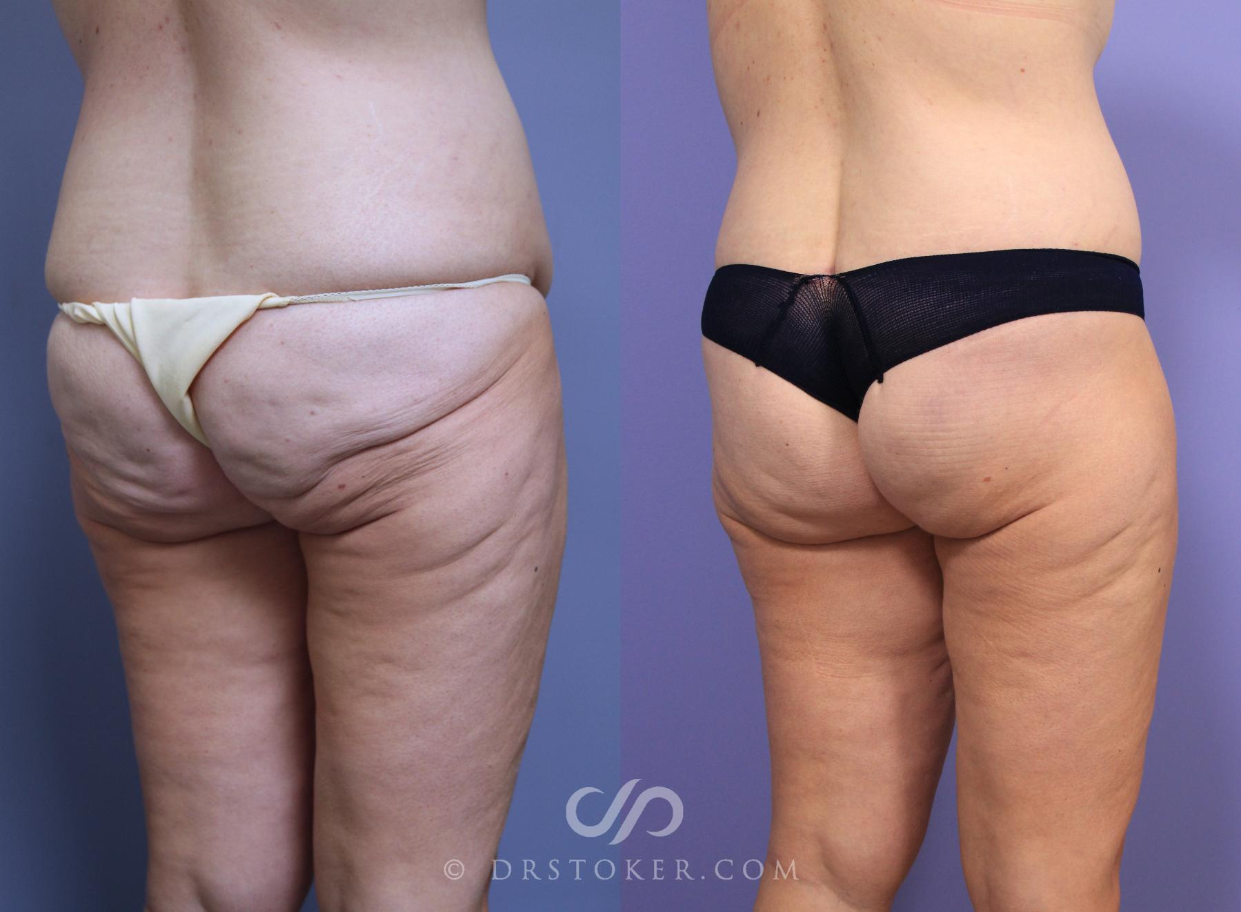 Before & After After Weight Loss Case 646 View #2 View in Los Angeles, CA