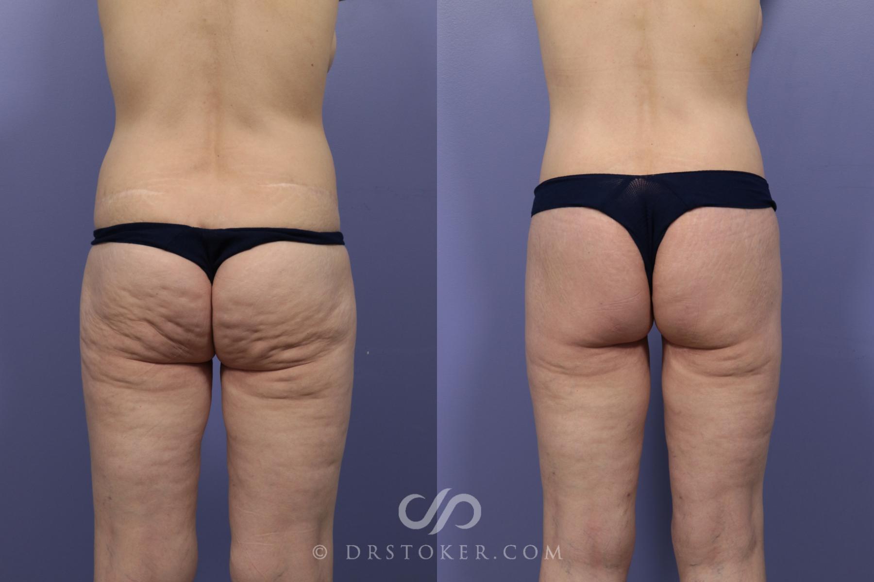 Before & After After Weight Loss Case 647 View #1 View in Los Angeles, CA