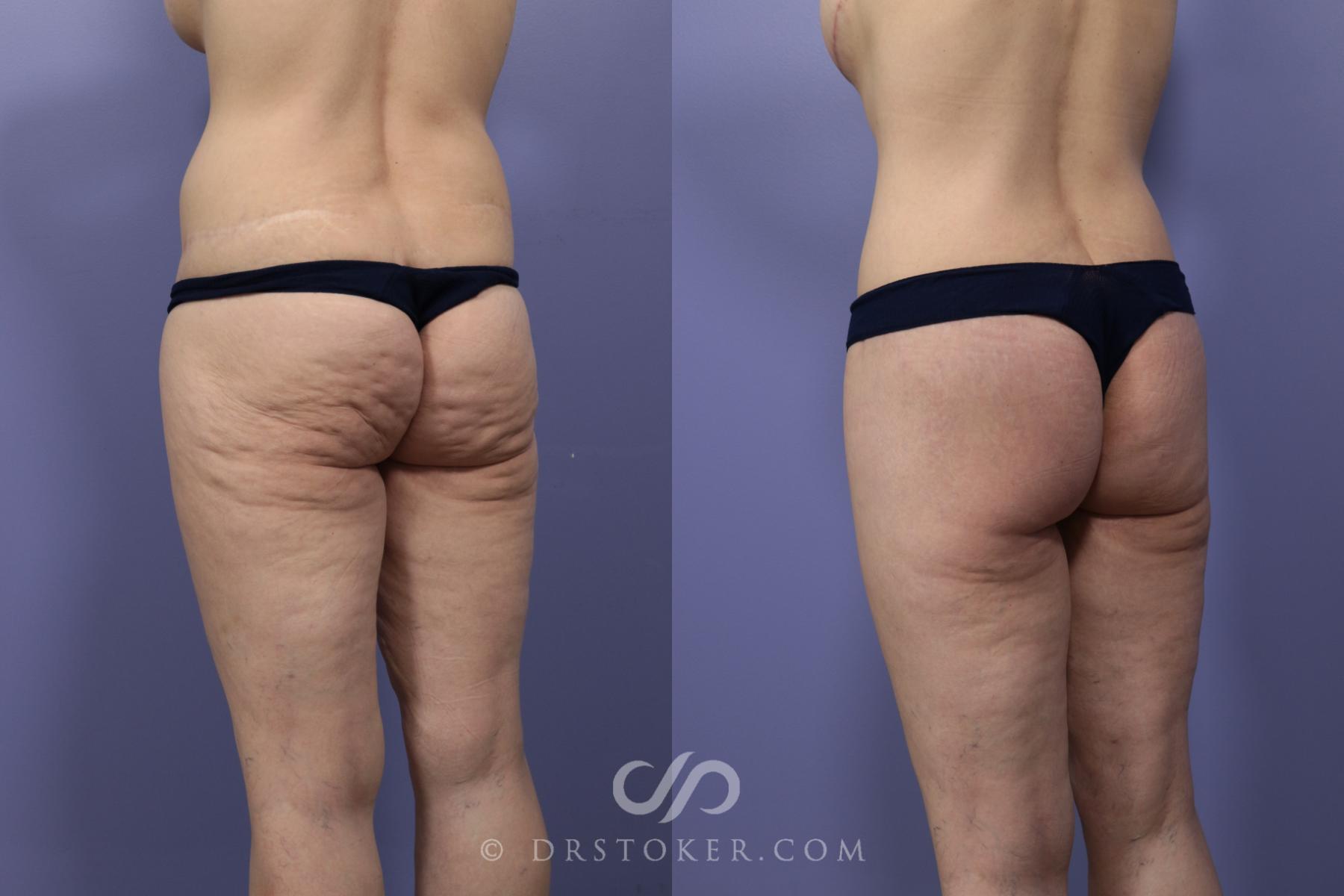Before & After After Weight Loss Case 647 View #2 View in Los Angeles, CA