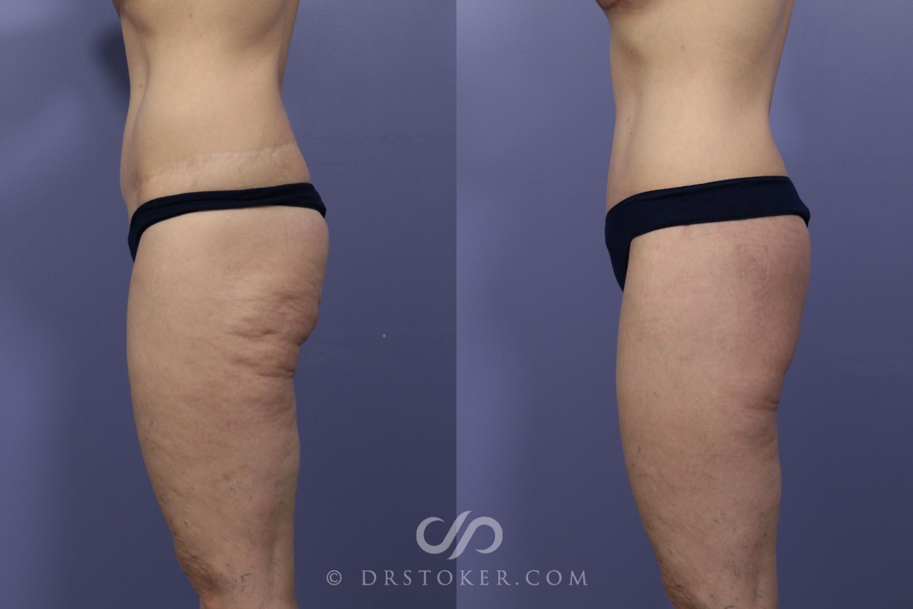 Before & After After Weight Loss Case 647 View #3 View in Los Angeles, CA