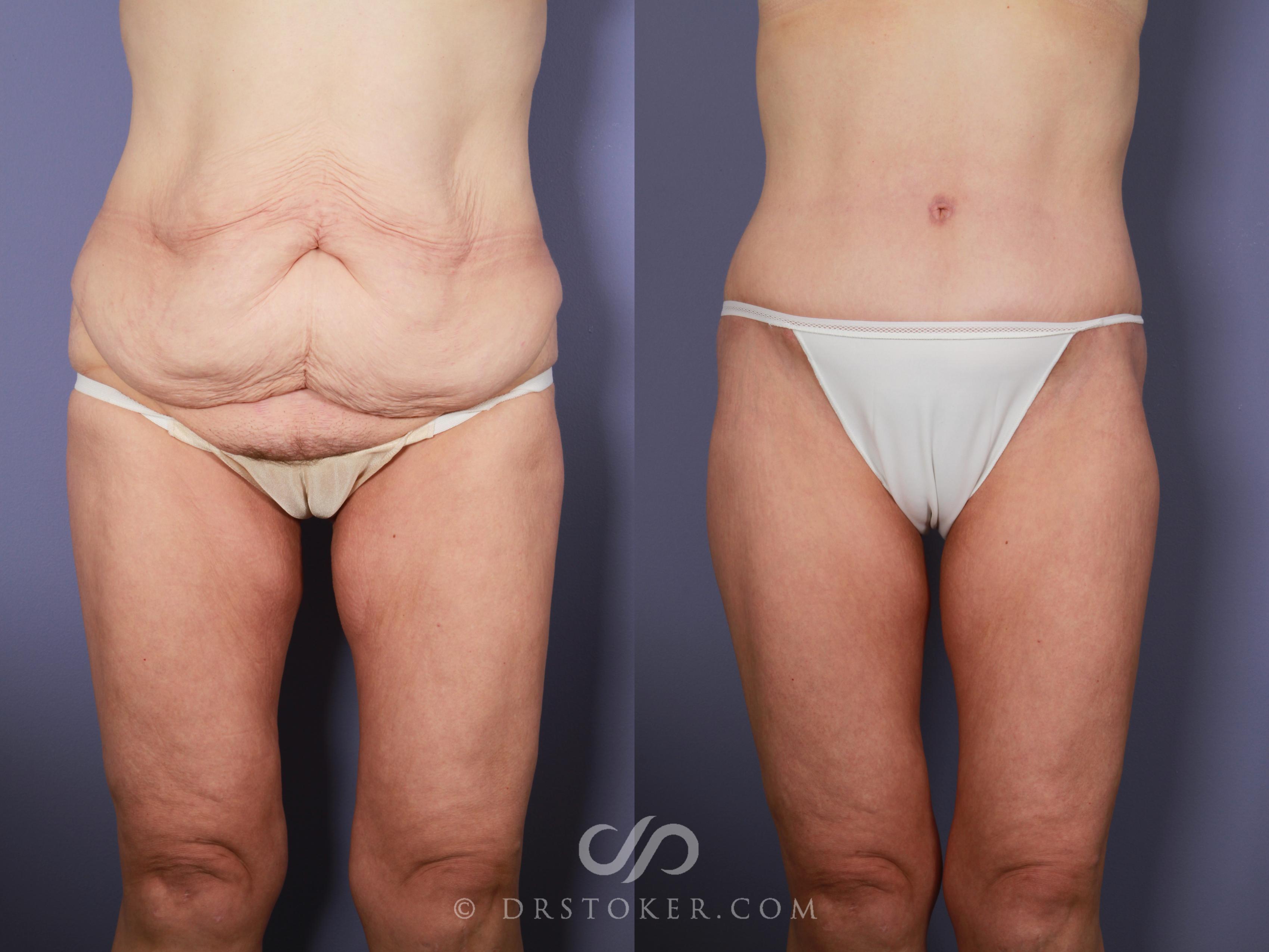 Before & After After Weight Loss Case 649 View #1 View in Los Angeles, CA