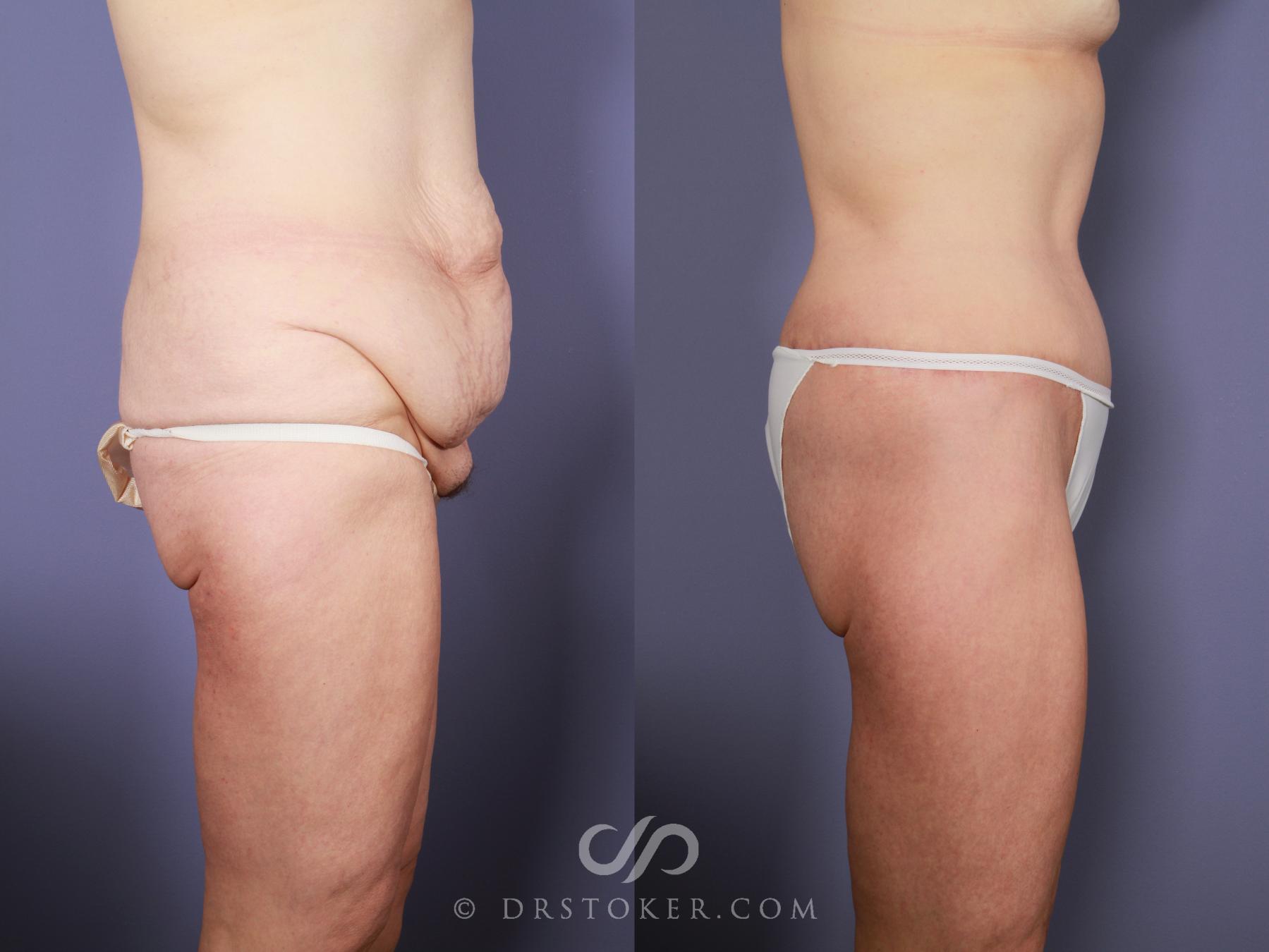 Before & After After Weight Loss Case 649 View #3 View in Los Angeles, CA
