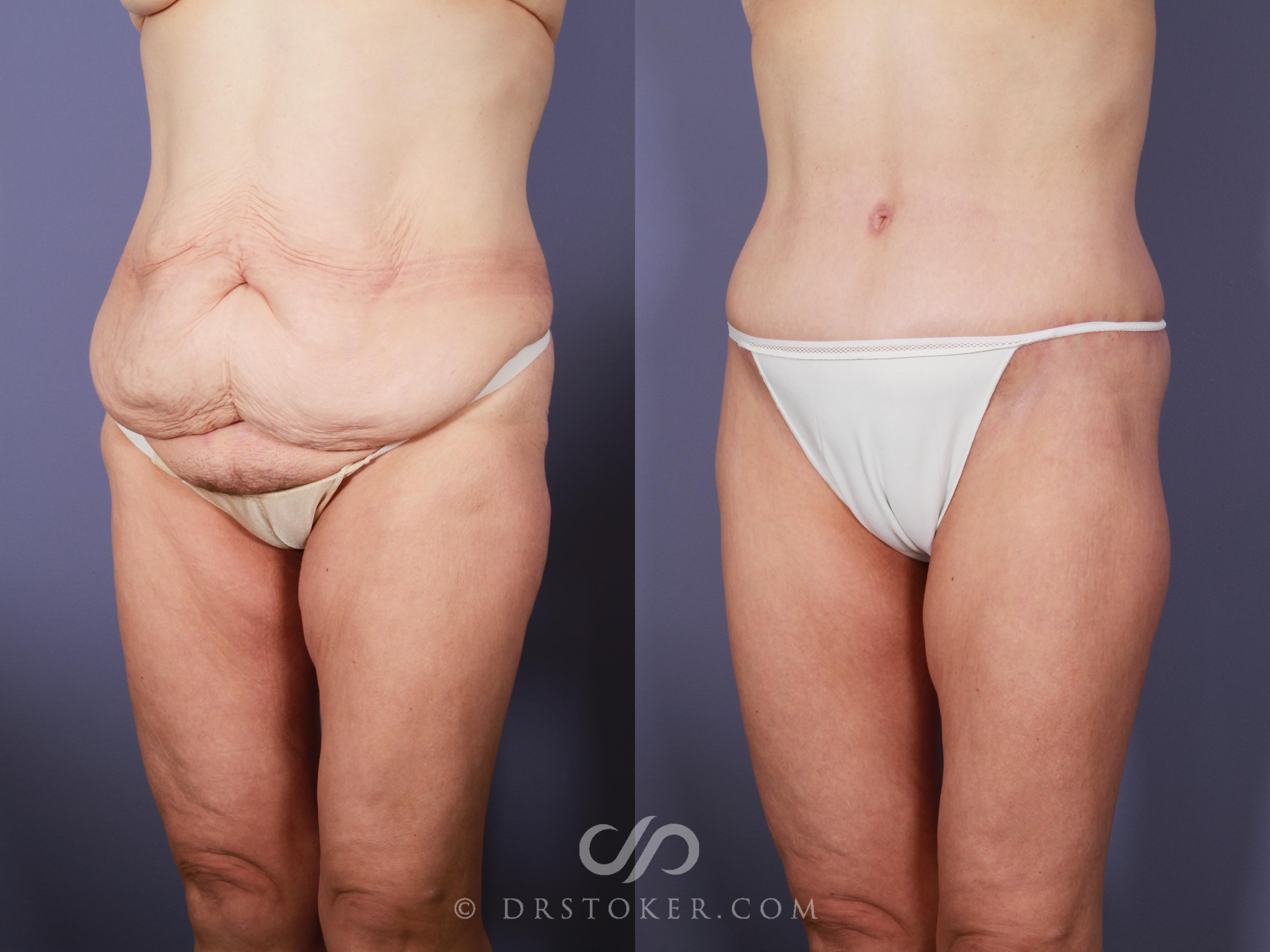 Before & After After Weight Loss Case 649 View #4 View in Los Angeles, CA