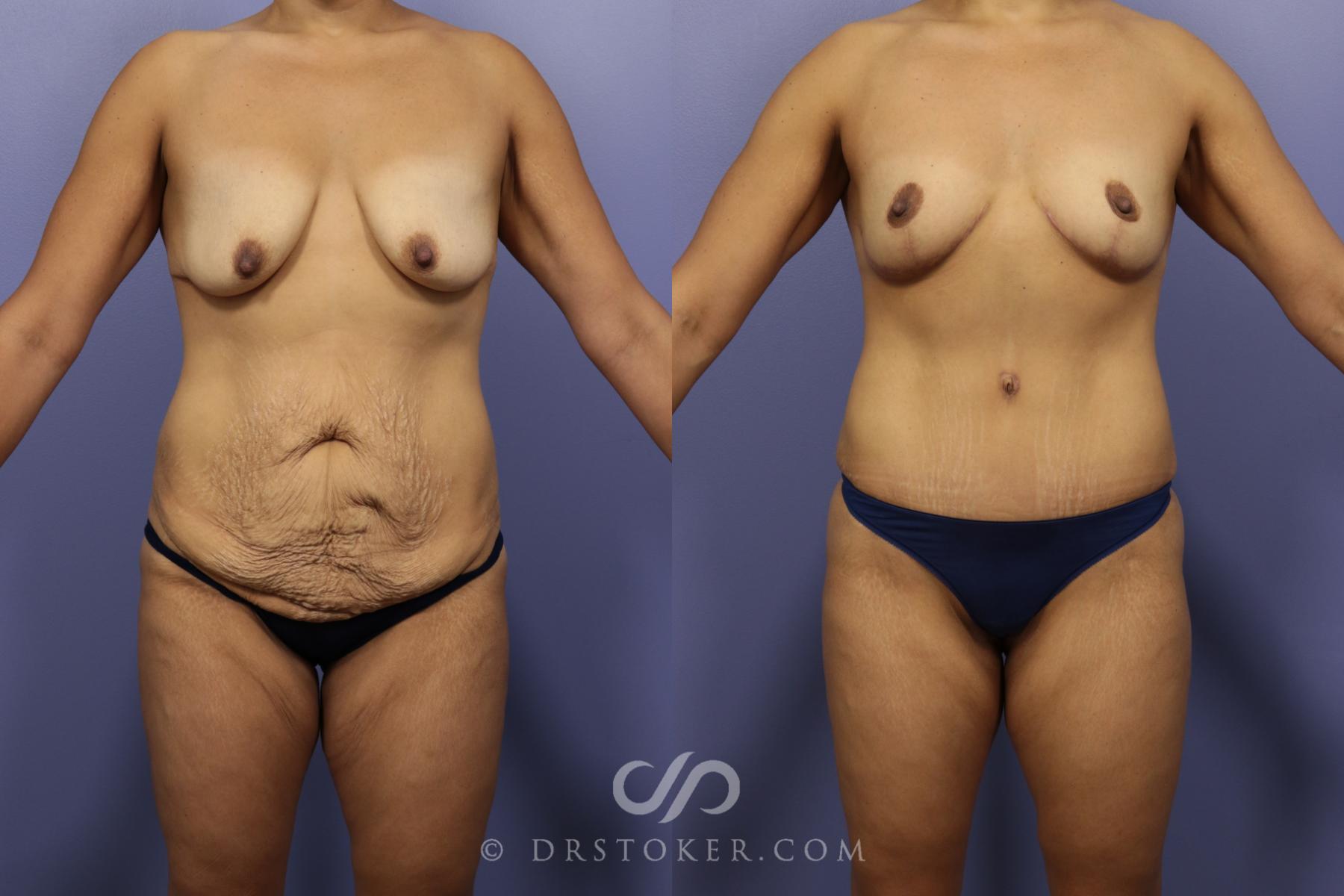 Before & After After Weight Loss Case 653 View #1 View in Los Angeles, CA