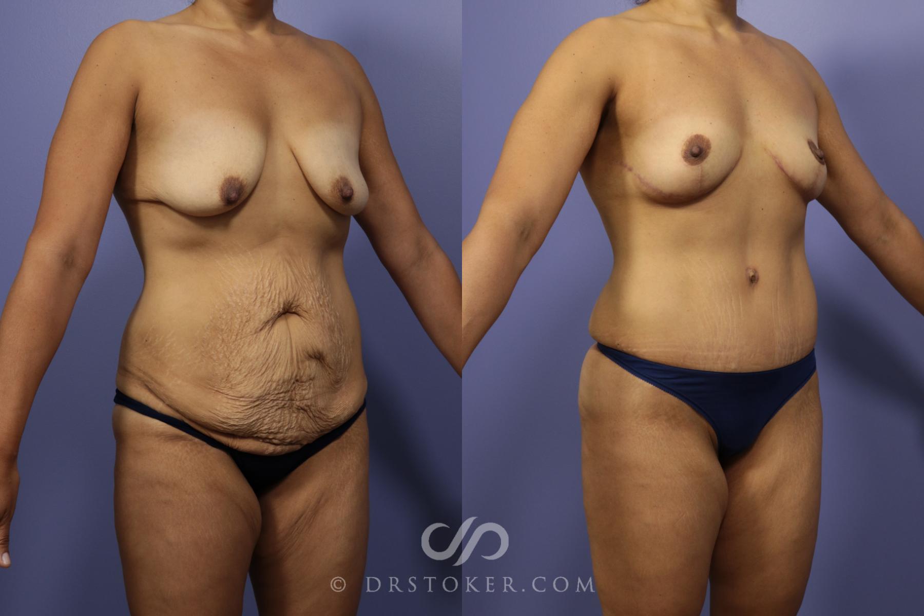 Before & After After Weight Loss Case 653 View #2 View in Los Angeles, CA