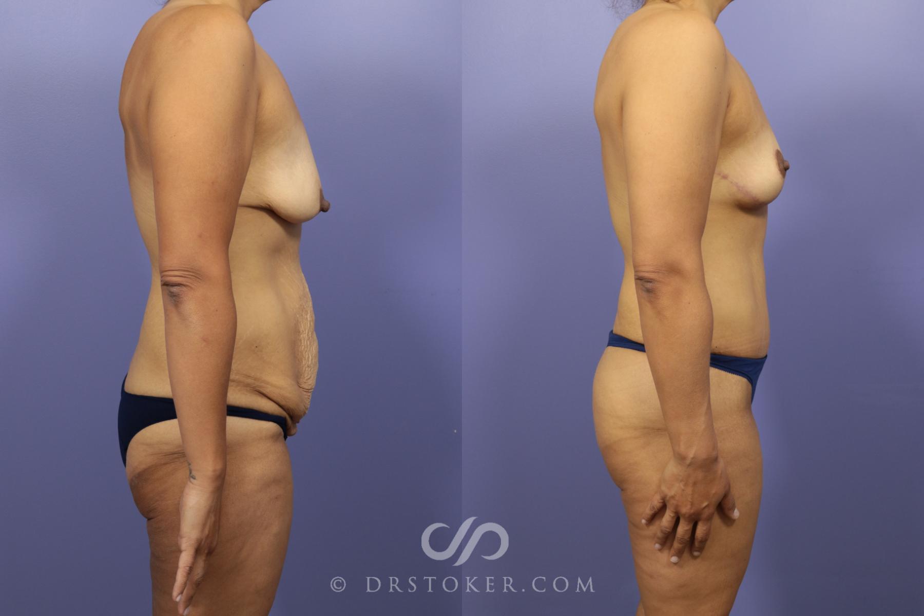 Before & After After Weight Loss Case 653 View #3 View in Los Angeles, CA