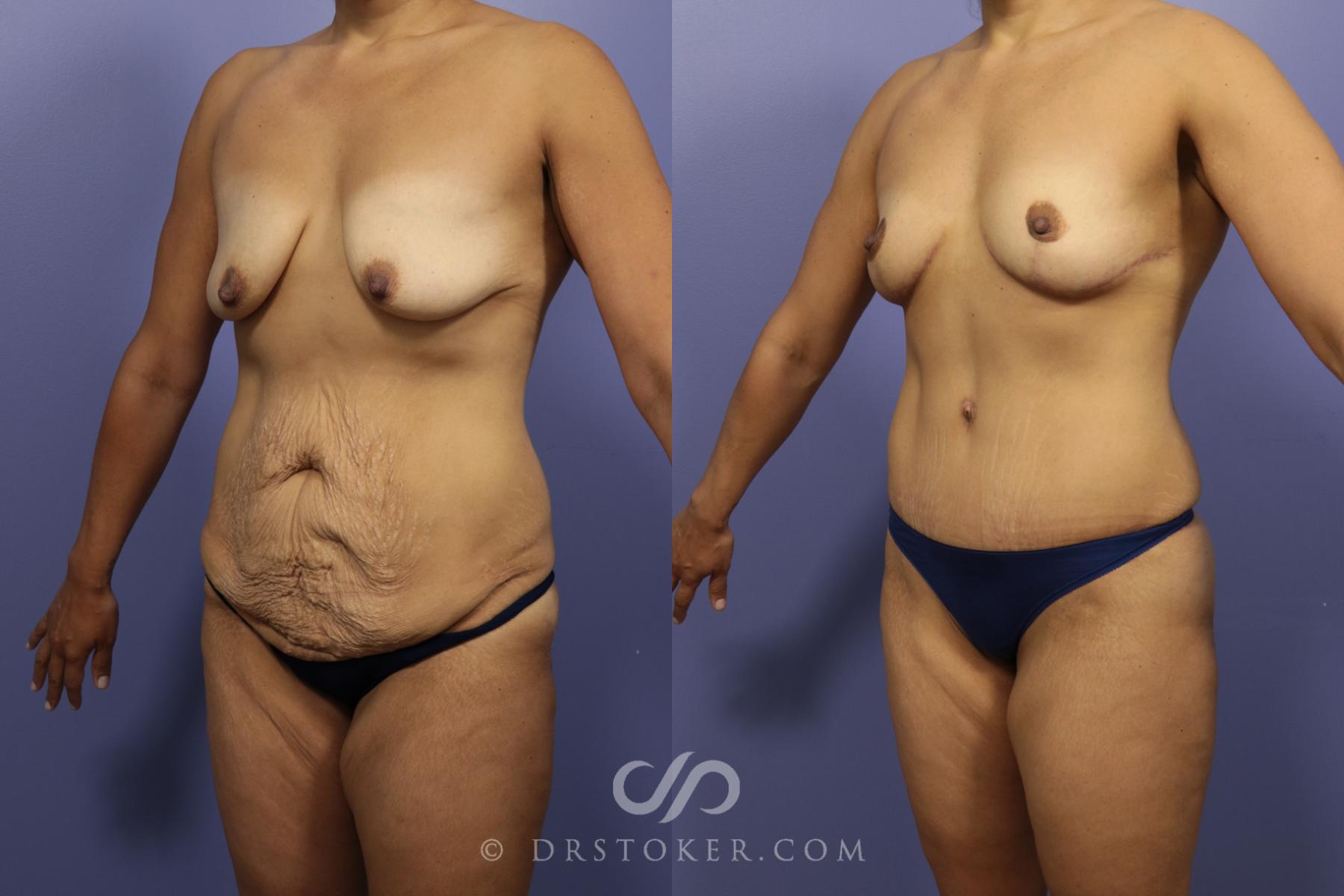 Before & After After Weight Loss Case 654 View #1 View in Los Angeles, CA