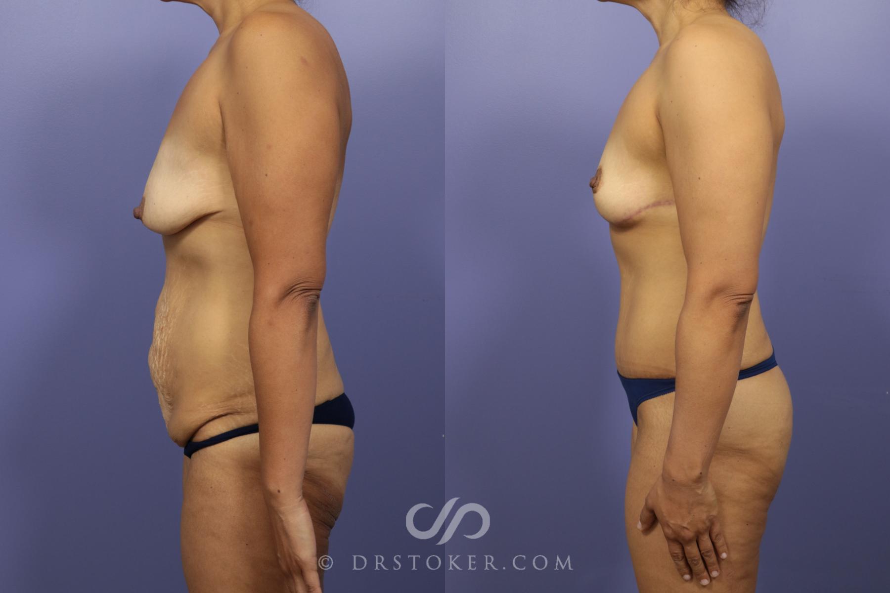 Before & After After Weight Loss Case 654 View #2 View in Los Angeles, CA