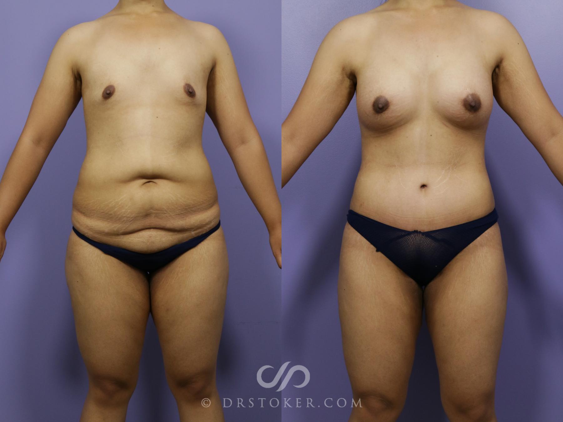 Before & After After Weight Loss Case 656 View #1 View in Los Angeles, CA