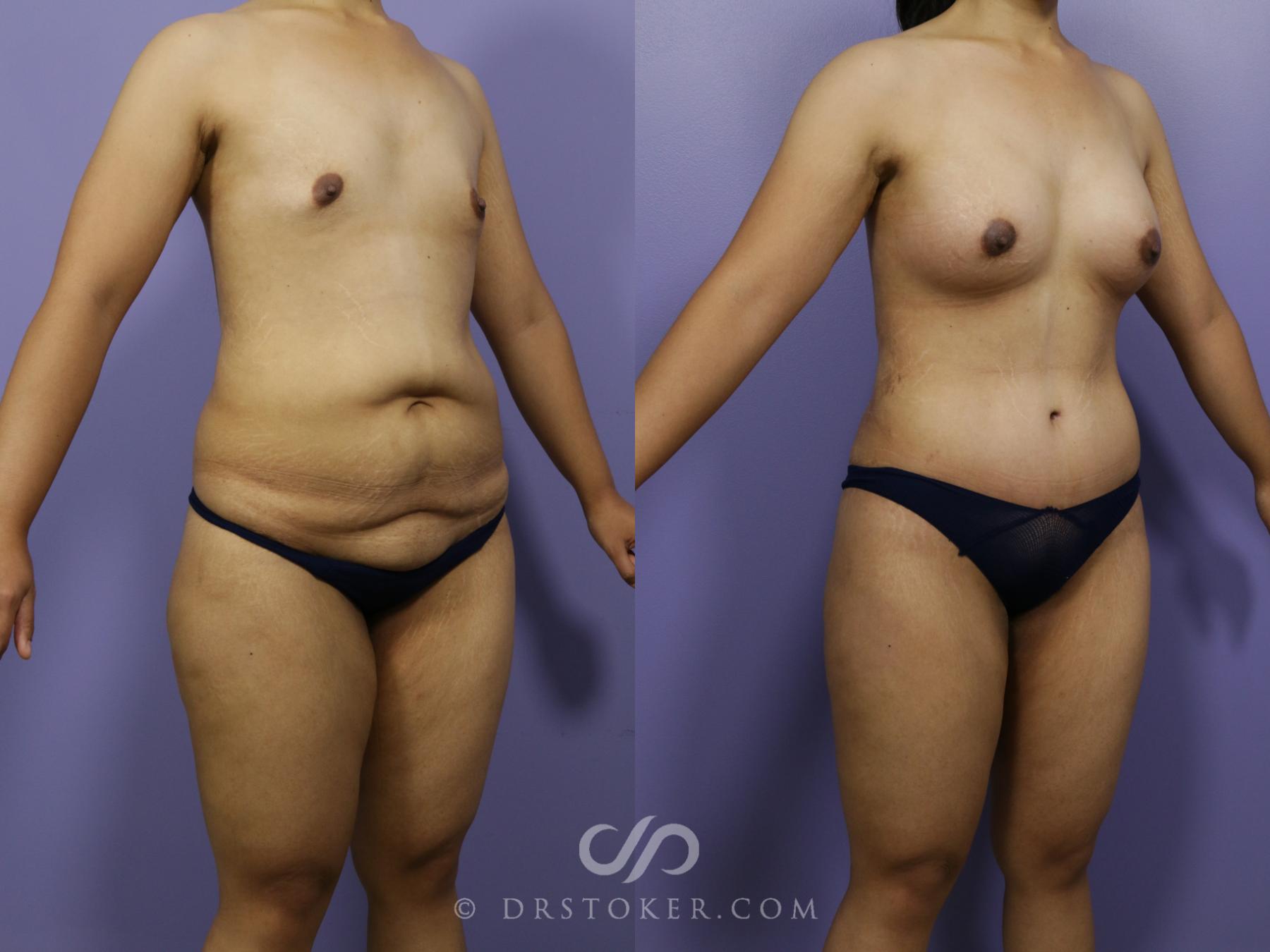 Before & After After Weight Loss Case 656 View #2 View in Los Angeles, CA